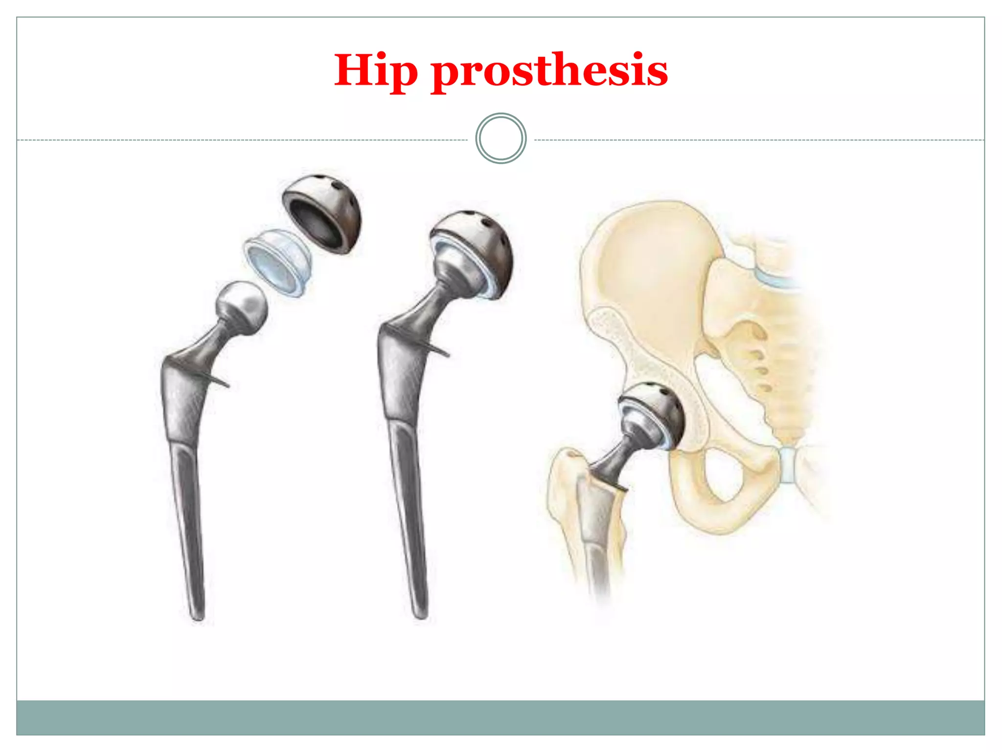 Prosthetic Body Parts PPT