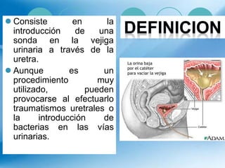  Consiste en la
introducción de una
sonda en la vejiga
urinaria a través de la
uretra.
 Aunque es un
procedimiento muy
utilizado, pueden
provocarse al efectuarlo
traumatismos uretrales o
la introducción de
bacterias en las vías
urinarias.
 
