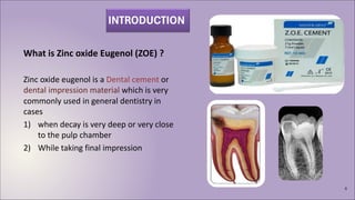 Zinc oxide eugenol as a cement and paste | PDF