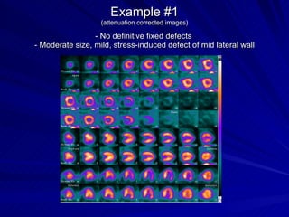 Example #1 (attenuation corrected images) - No definitive fixed defects  - Moderate size, mild, stress-induced defect of mid lateral wall 
