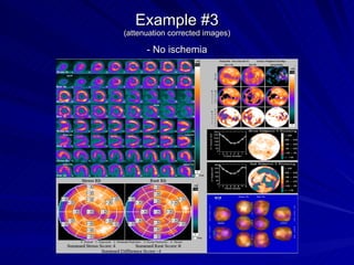 Example #3 (attenuation corrected images) - No ischemia 