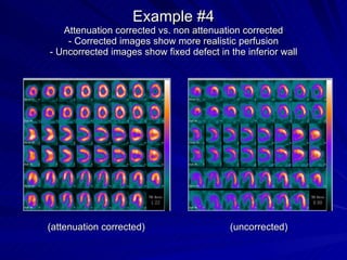 Example #4 Attenuation corrected vs. non attenuation corrected - Corrected images show more realistic perfusion - Uncorrected images show fixed defect in the inferior wall (attenuation corrected)  (uncorrected) 