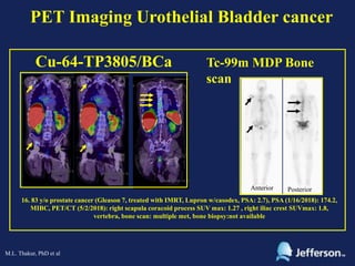 PET Imaging of Urothelial Bladder Cancer | PPTX