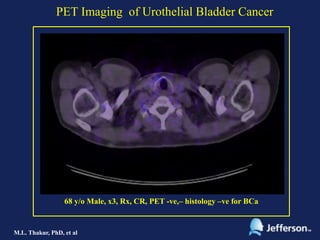 PET Imaging of Urothelial Bladder Cancer | PPTX