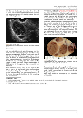 Nguyên tắc tiếp cận và quản lý một khối ở phần phụ
Quản lý các cấu trúc cơ năng tại buồng trứng
3
Nếu chảy máu v n kh ng tự cầm, hoàng thể có thể bị vỡ
và gây ra xu t huyết nội do vỡ nang hoàng thể. Nếu chảy
máu tự cầm, nhưng hoàng thể chứa máu bị căng, sẽ có một
khối ở phần phụ gây đau.
Hình 4: Hoàng thể xuất huyết
Hoàng thể to ra do bị xuất huyết trong lòng nang, tạo phản âm dạng lưới
điển hình.
Nguồn: pinterest.com
Một bệnh nhân điển hình là người kh ng đang thực hiện
tránh thai bằng estrogen-progestogen phối hợp đường
uống, có chu kỳ kinh đ u, đến khám vì triệu chứng đau c p
tính vùng bụng dưới khi đang ở trong giai đoạn trễ của pha
hoàng thể. Một số r t nhỏ bệnh nhân biểu hiện bằng triệu
chứng của chảy máu trong bụng, đ i khi cần được ph u
thuật để cầm máu. ới những bệnh nhân còn lại, cơn đau
c p tính và sự m t máu tự giới hạn. Các bệnh nhân này có
thể được xử trí với thuốc giảm đau nh và tr n an tinh thần
bệnh nhân.
Nhóm bệnh nhân có nang hoàng thể xu t huyết tái phát
hoặc có nguy cơ tái phát bao gồm những bệnh nhân đang
sử dụng thuốc chống đ ng máu và hoặc đang mắc chứng
rối loạn đ ng máu. Bệnh cảnh này có thể trở thành lý do
để các nhà lâm sàng tiến hành khảo sát chức năng đ ng
máu của bệnh nhân.
N N O N N (PREGNANCY LUTEOMA)
Điểm khác biệt quan trọng nh t giữa nang hoàng tuyến và
nang hoàng thể là nang hoàng tuyến hình thành do toàn bộ
các c u tr c noãn nang (kể các noãn nang còn nhỏ, chưa
phóng noãn) bị kích thích bởi hCG. Th ng thường, chỉ có
các nồng độ hCG cực cao mới gây nang hoàng tuyến.
Bệnh cảnh thường th y nh t là nang hoàng tuyến trong
thai trứng hay trong thai kỳ với đa thai. Thai kỳ cũng có
thể gây hình thành nang hoàng tuyến, nhưng với mức độ
kích thích yếu hơn, do nồng hCG kh ng phải là quá cao
như trong thai trứng. Sử dụng hCG ngoại sinh để gây
phóng noãn trong đi u trị hiếm muộn cũng có thể gây kích
hoạt quá đáng các c u tr c nang noãn, và gây ra một dạng
đặc biệt của tình trạng này, gọi là hội chứng quá kích
buồng trứng (hyperreactio futeinalis).
Hình 5: Nang hoàng tuyến
Khối u đặc tạo bởi các thành phần tế bào vỏ-hạt bị kích thích mạnh bởi
hCG. Sẽ tự thoái triển khi nguồn cấp hCG bị cắt đứt.
Nguồn: wikipedia.org
Do t t cả các c u tr c noãn nang đ u bị kích thích nên
nang hoàng tuyến thường gặp cùng l c ở cả hai buồng
trứng. Các c u tr c noãn nang phì đại, tạo ra một c u tr c
dạng hỗn hợp, r t to.
Nang hoàng tuyến sẽ tự thoái triển khi kích thích bằng
hCG kết th c.
I LIỆ ĐỌC ÊM
1. Obstetrics and gynecology 7th
edition. Tác giả Beckmann. Hợp tác xu t bản với ACOG. Nhà xu t bản Wolters Kluwer Health 2014.
I LIỆ M K ẢO C ÍN
1. WHO. WHO classification of tumours of female reproductive organs. 4th
edition. 2014.
 