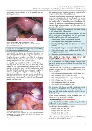 Nguyên tắc tiếp cận và quản lý một khối ở phần phụ
Phân loại khối u buồng trứng theo Tổ chức Y tế Thế giới. Đặc điểm lâm sàng của các khối u buồng trứng
2
trên siêu âm. Cường androgen có thể rất nặng đến mức gây
rậm lông (hirsutism).
Hình 2: Buồng trứng đa nang nhìn qua nội soi ổ bụng
Cả hai buồng trứng to đều do có rất nhiều nang thứ cấp muộn nhỏ.
Nguồn: queenswaygynaecologyclinic.com
Lạc nội mạc tử cung ở buồng trứng là một cấu trúc không
tân lập có ý nghĩa quan trọng nhất.
Lạc tuyến nội mạc tử cung tại buồng trứng là một cấu trúc
không tân lập lành tính, gây đau vùng chậu và hiếm muộn.
Nang lạc nội mạc tử cung được hình thành do sự cấy ghép
lên bề mặt buồng trứng của mô nội mạc tử cung bình
thường có nguồn gốc từ máu kinh trào ngược.
Sự cấy ghép này được tiếp nhận khi có các bất thường về
đáp ứng miễn dịch thải trừ mô cấy ghép. Khi có bất
thường về khả năng đáp ứng miễn dịch (có thể do liên
quan đến các đột biến gene), cấy ghép bất thường sẽ thành
công dẫn đến hình thành các tuyến nội mạc tử cung lạc vị,
vẫn còn hoạt động chức năng trên bề mặt buồng trứng.
Xuất huyết kinh làm cho các nang bịt này lớn dần lên do
chứa đầy máu “kinh” không có đường thoát, gây ra một
cấu trúc nang, với đặc trưng là viêm, với tân mạch và tàn
phá cấu trúc vùng chậu.
Hình 3: Nang lạc nội mạc tử cung
Nang chứa dịch chocolate hình thành do ứ máu “kinh” trong bề mặt
buồng trứng. Viêm là hiện tượng đi kèm rất phổ biến, gây dính vùng
chậu, với hệ quả là hiếm muộn.
Nguồn: pinterest.com
Khả năng ác tính của nang lạc nội mạc tử cung tại buồng
trứng là rất thấp, nhưng không thể loại trừ.
Chẩn đoán phân biệt quan trọng nhất của nang lạc nội mạc
tử cung tại buồng trứng là u tân sinh dạng nội mạc tử cung
của buồng trứng, là một tân lập, với tế bào giống tế bào nội
mạc, nhưng không có mô đệm tùy hành. Nếu như bản chất
của nang lạc nội mạc tử cung tại buồng trứng lành tính, thì
các nang dạng nội mạc tử cung của buồng trứng có liên
quan mạnh đến ác tính.
Các cấu trúc tân lập được phân loại dựa trên nguồn gốc mô
và phôi học của thành phần tân sinh.
Phân loại dựa trên nguồn gốc mô học và phôi học giúp
hiểu rõ được tính đa dạng về hình thái, tiên lượng, cũng
như hệ thống hóa các tân sinh của buồng trứng 4
.
1. U xuất phát từ thượng mô (epithelial tumours)
2. U xuất phát từ tế bào mầm (germ cell tumours)
3. U xuất phát từ dây giới bào-mô đệm (sex cord-stromal
tumours)
4. U xuất phát từ trung mô (mesenchymal tumours)
5. U tân sinh có nguồn gốc ở nơi khác di căn đến buồng
trứng (secondary tumours)
6. Những tổn thương giống u (tumour-like lesions)
CÁC KHỐI U TÂN SINH PHÁT XUẤT TỪ
THƯỢNG MÔ (EPITHELIAL TUMOURS)
Đây là tân sinh của các tế bào tại buồng trứng có nguồn
gốc xa xôi là biểu mô nguyên thủy đi theo các tế bào sinh
dục nguyên thủy.
Trong tân sinh này, các tế bào sẽ có dạng của một trong
các dạng mà các tế bào biểu mô lát lòng ống Muller có thể
chuyển dạng được.
1. Biểu mô trụ thấp có lông chuyển: U tuyến thanh dịch
2. Biểu mô trụ tiết nhầy: U tuyến dịch nhầy
3. Biểu mô trụ tuyến nội mạc: U dạng nội mạc tử cung
4. Biểu mô dạng ống: U tế bào sáng
5. Biểu mô kiểu chuyển tiếp: U Brenner
6. U tế bào ống Muller hỗn hợp ác tính
Đây là các tân sinh thường gặp nhất của cấu trúc tân lập
buồng trứng, chiếm 50-60% các khối u buồng trứng.
Đáng ngại nhất là các tân lập này chiếm đến 85% các ung
thư buồng trứng.
Về mặt mô học, chúng được cấu tạo từ một hay nhiều kiểu
thượng mô và có sự thay đổi ở mô đệm.
U tuyến thanh dịch (serous cystadenoma)
Lòng u được lát bởi các tế bào trụ thấp, giống như tế bào
của biểu mô lát lòng vòi trứng.
U tuyến thanh dịch buồng trứng có thể là:
 U tuyến thanh dịch lành tính
 U tuyến thanh dịch giáp biên ác
 U tuyến thanh dịch ác tính
4
Thuật ngữ trong bài là thuật ngữ theo ấn bản lần thứ tư, 2014. Thuật ngữ
này có thay đổi nhiều so với ấn bản lần thứ 3rd
.
 