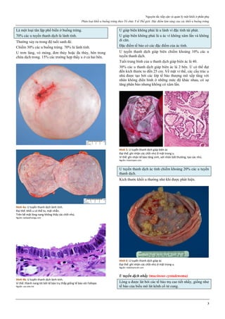 Nguyên tắc tiếp cận và quản lý một khối ở phần phụ
Phân loại khối u buồng trứng theo Tổ chức Y tế Thế giới. Đặc điểm lâm sàng của các khối u buồng trứng
3
Là một loại tân lập phổ biến ở buồng trứng.
70% các u tuyến thanh dịch là lành tính.
Thường xảy ra trong độ tuổi sanh đẻ.
Chiếm 30% các u buồng trứng. 70% là lành tính.
U trơn láng, vỏ mỏng, đơn thùy hoặc đa thùy, bên trong
chứa dịch trong. 15% các trường hợp thấy u ở cả hai bên.
Hình 4a: U tuyến thanh dịch lành tính.
Đại thể: khối u có thể to, mặt nhẵn.
Trên bề mặt lòng nang không thấy các chồi nhú.
Nguồn: webpathology.com
Hình 4b: U tuyến thanh dịch lành tính.
Vi thể: thành nang lót bởi tế bào trụ thấp giống tế bào vòi Fallope.
Nguồn: uaz.edu.mx
U giáp biên không phải là u lành vì đặc tính tái phát.
U giáp biên không phải là u ác vì không xâm lấn và không
di căn.
Đặc điểm tế bào có các đặc điểm của ác tính.
U tuyến thanh dịch giáp biên chiếm khoảng 10% các u
tuyến thanh dịch.
Tuổi trung bình của u thanh dịch giáp biên ác là 40.
30% các u thanh dịch giáp biên ác là 2 bên. U có thể đạt
đến kích thước to đến 25 cm. Về mặt vi thể, các cấu trúc u
nhú được tạo bởi các lớp tế bào thượng mô xếp tầng với
nhân không điển hình ở những mức độ khác nhau, có sự
tăng phân bào nhưng không có xâm lấn.
Hình 5: U tuyến thanh dịch giáp biên ác
Đại thể: ghi nhận các chồi nhú ở mặt trong u.
Vi thể: ghi nhận tế bào tăng sinh, với nhân bất thường, tạo các nhú.
Nguồn: intechopen.com
U tuyến thanh dịch ác tính chiếm khoảng 20% các u tuyến
thanh dịch.
Kích thước khối u thường nhỏ khi được phát hiện.
Hình 6: U tuyến thanh dịch giáp ác
Đại thể: ghi nhận các chồi nhú ở mặt trong u.
Nguồn: slidesharecdn.com
U tuyến dịch nhầy (mucinous cystadenoma)
Lòng u được lát bởi các tế bào trụ cao tiết nhầy, giống như
tế bào của biểu mô lát kênh cổ tử cung.
 
