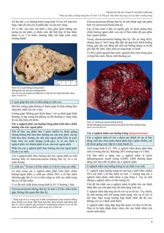 Nguyên tắc tiếp cận và quản lý một khối ở phần phụ
Phân loại khối u buồng trứng theo Tổ chức Y tế Thế giới. Đặc điểm lâm sàng của các khối u buồng trứng
6
Về đại thể, u có đường kính trung bình 18 cm, bề mặt trơn
láng, mặt cắt chủ yếu là phần đặc và cấu trúc nang.
Về vi thể, cấu trúc của khối u bao gồm gồm những mô
tương tự mô phôi, ở nhiều mức độ biệt hóa tế bào khác
nhau ở cả 3 lá mầm, thường thấy mô thần kinh chưa
trưởng thành.
Hình 10: U quái không trưởng thành
Không thấy các cấu trúc trưởng thành.
Các mô của các lá phôi chỉ thấy trên vi thể với mức biệt hóa khác nhau.
Nguồn: humpath.com
U quái giáp đơn mô có tiềm năng ác tính cao.
Đôi khi cường giáp không có bướu giáp là triệu chứng lâm
sàng duy nhất của các u này.
Cường giáp “không giải thích được” với xạ hình giáp bình
thường và tập trung Iod phóng xạ bất thường ở vùng chậu
là các dấu hiệu chỉ điểm.
Các u nghịch phôi của buồng trứng phát triển theo chiều
hướng cấu trúc ngoài phôi
Nếu tế bào sau phân bào I giảm nhiễm bị thoái giáng
nhưng không biệt hóa theo hướng các cấu trúc phôi, mà lại
biệt hóa theo hướng các cấu trúc ngoài phôi kiểu lá nuôi
hoặc kiểu túi noãn hoàng (yolk-sac), ta sẽ các khối u
nghịch phôi với thành phần là các cấu trúc ngoài phôi.
Phần lớn các u nghịch phôi theo hướng cấu trúc ngoài phôi
là các u ác tính.
Các u nghịch phôi theo hướng cấu trúc ngoài phôi ác tính
thường thấy là choriocarcinoma không thai kỳ và u túi
noãn hoàng.
U yolk-sac 6
là loại u tế bào mầm có tỉ lệ tử vong cao nhất.
Là một trong các u nghịch phôi phát triển theo chiều
hướng ngoài phôi, u yolk-sac chiếm 20% u tế bào mầm
(thường gặp thứ 2) và có tiềm năng ác tính cao nhất trong
tất cả u tế bào mầm.
U có độ tuổi chẩn đoán trung bình là 19. U thường 1 bên.
Choriocarcinoma không thai kỳ là một u tế bào mầm hiếm
gặp, không liên quan đến thai kỳ.
6
Thuật ngữ cũ là u xoang nội bì phôi (endodermal sinus tumour) không
được khuyến cáo dùng. Một thuật ngữ khác được khuyến nghị dùng gần
đây là u nội bì nguyên phát (primitive endodermal tumour) vì nó nói lên
được các cấu thành của khối u gồm trung mô và biểu mô.
Choriocarcinoma không thai kỳ là một thuật ngữ cần phân
biệt với choriocarcinoma thai kỳ.
Các tế bào nuôi ở đây có nguồn gốc từ thoái giáng theo
chiều hướng ngoài phôi của các tế bào mầm đã qua phân
bào I giảm nhiễm.
Trong choriocarcinoma không thai kỳ vẫn có tăng hCG,
nhưng tăng ít. hCG tăng dẫn đến hệ quả kích thích buồng
trứng, gây nên các động nội tiết của buồng trứng và từ đó
gây dậy thì sớm, chảy máu tử cung hoặc vô kinh.
Vi thể u gồm nguyên bào nuôi, nguyên bào nuôi trung gian
và hợp bào nuôi. Độ ác tính thường cao.
Hình 11: Choriocarcinoma không thai kz
Về đại thể giống choriocarcinoma thai kz di căn trên buồng trứng.
Nguồn: basicmedicalkey.com
Các u nghịch mầm của buồng trứng (dysgerminoma)
Các u nghịch mầm là các u được tạo thành từ các tế bào
dòng sinh dục chưa hoàn thành phân bào I giảm nhiễm, mà
đã thoái giáng trực tiếp từ n kép thành 2n.
Tuổi trung bình là 22. 50% u nghịch mầm được phát hiện
tình cờ trong thai kỳ. Khoảng 20% trường hợp u ở 2 bên.
Chỉ báo khối u dùng cho u nghịch mầm là lactic
dehydrogenase huyết tương (LDH). LDH thường được
dùng cho theo dõi tái phát của u nghịch mầm.
U nghịch mầm của buồng trứng là các khối u ác tính
U nghịch mầm buồng trứng là một loại u phổ biến, chiếm
45% các khối u tế bào mầm ác tính. ⅔ trường hợp các u
nghịch mầm được chẩn đoán ở giai đoạn I. Tuy ác tính
nhưng u nghịch mầm có tiên lượng tốt.
Vấn đề lớn nhất của u nghịch mầm là phần lớn các bệnh
nhân đều còn cần phải bảo tồn khả năng sinh sản.
U nghịch mầm đáp ứng rất tốt với xạ trị bổ túc. Tuy nhiên,
do ảnh hưởng trên trữ lượng noãn nang, nên xạ trị chỉ có
thể thực hiện trong trường hợp bệnh nhân đã đủ con,
không còn có ý định sanh thêm.
U nghịch mầm cũng đáp ứng khả quan với hóa trị bổ túc.
Hóa trị là biện pháp được chọn cho các bệnh nhân còn
muốn sanh thêm.
 