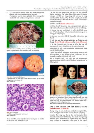 Nguyên tắc tiếp cận và quản lý một khối ở phần phụ
Phân loại khối u buồng trứng theo Tổ chức Y tế Thế giới. Đặc điểm lâm sàng của các khối u buồng trứng
8
 95% type mô học trưởng thành, xảy ra vào những năm
đầu sau mãn kinh (adult granulosa tumour).
 5% type mô học trẻ xảy ra giữa dậy thì và những năm
đầu thời kì sinh sản (juvenile granulosa tumour).
Hình 15: U tế bào hạt thể người lớn, với kết hợp của tế bào vỏ.
Là một u có mặt cắt nhìn giống như u dịch nhầy, với xuất huyết.
Hình 16: U tế bào hạt thể thiếu niên
U thể thiếu niên với tiềm năng ác tính rất thấp, thường khu trú ở một
buồng trứng và tiên lượng tốt.
Nguồn: humpath.com
Hình 17: U tế bào hạt
Vi thể đặc trưng bởi các thể “Call-Exner”.
Nguồn: studyblue.com
Do là một khối u chế tiết, nên steroid (estrogen) và Inhibin
có thể là hai chất đánh dấu có ích.
Các dấu hiệu lâm sàng là các dấu hiệu của hiện diện bất
thường estrogen. Các triệu chứng liên quan với cường
estrogen với khối u ở bụng, tăng sinh nội mạc tử cung,
xuất huyết bất thường. Dậy thì sớm, rong huyết đôi khi
xuất hiện đơn độc, như một chỉ báo khối u. Đau do vỡ u
không thường gặp.
U tế bào Sertoli (Sertoli cell tumour)
U tế bào Sertoli là một tân sinh xuất phát từ dây giới bào
biệt hóa theo hướng nam. Là một u hiếm, với ác tính thấp.
U thường xảy ra ở người dưới 30 tuổi, và chế tiết trong
hơn 95% trường hợp. U Sertoli đơn thuần thường có xu
hướng chế tiết estrogen.
U gây nam hóa, và vì thế dễ được phát hiện sớm ở giai
đoạn I.
U hỗn hợp mô đệm và dây giới bào: u tế bào Sertoli-
Leydig (Sertoli-Leydig cell tumour) hay (androblastoma)
U tế bào Sertoli-Leydig là một u hiếm. Do chế tiết
androgen nên u này còn có tên gọi là Androsblastoma.
Nhìn chung, là một u với ác tính thấp, nhưng còn lệ thuộc
vào độ biệt hóa tế bào.
Loại u này chế tiết androgen. 40-60% bệnh nhân có biểu
hiện rậm lông, vú teo, phì đại âm vật. U cũng gây dậy thì
sớm, gây rong huyết ở trẻ gái mắc bệnh.
Với u Sertoli-Leydig, các khảo sát như testosterone,
androstenedione, và tiền chất 17-hydroxy progesterone có
thể có giá trị.
Hình 18: U tế bào Sertoli-Leydig với biểu hiện cường Androgen
Một bé gái, 14 tuổi, khám vì mọc ria mép và lông ngực. Bé đã được phẫu
thuật cắt u buồng trứng loại tế bào Sertoli-Leydig. Hình trái và hình giữa
là ảnh chụp trước mổ của bé. Hình trên cùng bên phải là ảnh chụp 6
tháng sau khi mổ cắt buồng trứng có u.
Nguồn: Pediatrics in Review. July 2001,22(7). pedsinreview.aappublications.org
CÁC U TÂN SINH DI CĂN ĐẾN BUỒNG TRỨNG
(SECONDARY TUMOUR)
Buồng trứng là nơi di căn của nhiều loại ung thư khác
nhau, nhưng phổ biến nhất là các ung thư các tạng bụng.
Ung thư đại tràng, ung thư dạ dày các là ung thư được
nhắc đến nhiều nhất về khả năng cho di căn buồng trứng,
dưới tên gọi u Krukenberg. Khi phẫu thuật một u buồng
trứng có dạng u Krukenberg, buộc phải đi tìm khối u
 