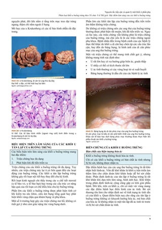 Nguyên tắc tiếp cận và quản lý một khối ở phần phụ
Phân loại khối u buồng trứng theo Tổ chức Y tế Thế giới. Đặc điểm lâm sàng của các khối u buồng trứng
9
nguyên phát, đôi khi nằm ở tầng trên mạc treo đại tràng
ngang, thậm chí nằm ngoài ổ bụng.
Mô học của u Krukenberg có các tế bào hình nhẫn rất đặc
trưng.
Hình 19: U Krukenberg, di căn từ ung thư dạ dày
Đại thể: u đặc, có thể một hay hai bên.
Nguồn: pathologyoutlines.com
Hình 20: U Krukenberg
Vi thể: Các tế bào hình nhẫn (signet ring cell) kinh điển trong u
Krukenberg di căn từ dạ dày.
Nguồn: webpathology.com
BIỂU HIỆN TRÊN LÂM SÀNG CỦA CÁC KHỐI U
TÂN LẬP CỦA BUỒNG TRỨNG
Các biểu hiện trên lâm sàng của khối u buồng trứng mang
hai đặc điểm:
1. Triệu chứng học đa dạng
2. Phát hiện khi đã tiến triển xa
Triệu chứng của các khối u buồng trứng rất đa dạng. Tuy
nhiên, các triệu chứng này lại ít có liên quan đến các hoạt
động của buồng trứng. Các khối u tân lập buồng trứng
không gây rối loạn nội tiết hay thay đổi chu kỳ kinh.
Rối loạn kinh nguyệt chỉ thấy trong các u chế tiết steroid
(u tế bào vỏ, u tế bào hạt) hay trong các cấu trúc cơ năng
hậu quả của rối loạn cơ chế điều hòa chu kỳ buồng trứng.
Phần lớn các khối u buồng trứng được phát hiện tình cờ
khi kiểm tra sức khỏe, siêu âm bụng tổng quát hay phát
hiện khối vùng chậu qua khám bụng và phụ khoa.
Một số ít trường hợp gây các triệu chứng mơ hồ, không có
tính gợi ý như cảm giác nặng tức vùng bụng dưới.
Phần lớn các khối tân lập của buồng trứng đều tiến triển
âm thầm không triệu chứng.
Do không có triệu chứng nên các ung thư của buồng trứng
thường được phát hiện rất muộn, khi đã tiến triển xa. Ngay
cả lúc này, các triệu chứng vẫn không phải là triệu chứng
của buồng trứng, mà chủ yếu là là các triệu chứng ngoài
phụ khoa. Bệnh nhân đến trong bệnh cảnh của các bệnh lý
thực thể khác do khối u di căn hay chèn ép các cấu trúc lân
cận, hay đến do báng bụng, là hình ảnh của di căn phúc
mạc của ung thư buồng trứng.
Một vài triệu chứng có thể mang tính chất gợi ý, nhưng
không mang tính xác định như:
 U rất lớn hay có xu hướng giáp biên ác, grade thấp
 U nhầy có thể có kích thước rất lớn
 U ác tính thường có các vùng hoại tử và xuất huyết
 Báng bụng thường là dấu chỉ của các bệnh lý ác tính
Hình 21: Báng bụng do di căn phúc mạc của ung thư buồng trứng
Di căn phúc mạc là kiểu di căn phổ biến nhất của ung thư buồng trứng.
Khảo sát tế bào học dịch báng phúc mạc thường được thực hiện khi
phẫu thuật các khối u buồng trứng.
Nguồn: cqmsjt.com
BIẾN CHỨNG CỦA KHỐI U BUỒNG TRỨNG
Bản chất của hiện tượng hóa ác
Khối u buồng trứng không thoái hóa ác tính.
Chỉ có các khối u buồng trứng có bản chất ác tính nhưng
bị bỏ sót, không được nhận ra.
Đặc điểm bệnh học của các ung thư buồng trứng là rất khó
nhận biết lành-ác. Vấn đề khó khăn là khối u tiến triển âm
thầm làm cho chẩn đoán khó khăn hoặc dễ bỏ sót chẩn
đoán. Phân định lành-ác của tân lập ở buồng trứng là rất
khó khăn khi dựa trên lâm sàng, hình ảnh học. Khó khăn
trong phân định lành-ác cũng cũng gặp cả trên giải phẫu
bệnh. Đôi khi, trên cả khối u, chỉ có một vài vùng mang
các đặc điểm bệnh học điển hình của ác tính. Bỏ sót
thương tổn làm cho nhận định sai về tình trạng ác tính sẵn
có của khối u. Quan điểm hiện nay cho rằng các tân lập ở
buồng trứng không có khuynh hướng hóa ác, mà bản chất
của hóa ác là không nhận ra một tân lập đã ác tính từ trước
và bị bỏ sót chẩn đoán ác tính.
 
