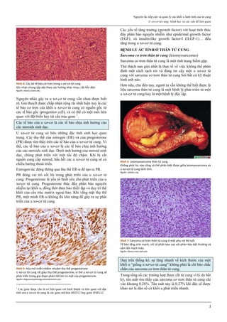 Nguyên tắc tiếp cận và quản lý các khối u lành tính của tử cung
U xơ-cơ tử cung: bệnh học và các vấn đề liên quan
2
Hình 4: Các bó tế bào cơ trơn trong u xơ-cơ tử cung
Ghi nhận chúng sắp xếp theo các hướng khác nhau, rất hỗn độn
Nguồn: www2.tulane.edu
Nguyên nhân gây ra u xơ-cơ tử cung vẫn chưa được biết
rõ. Giả thuyết được chấp nhận rộng rãi nhất hiện nay là các
tế bào cơ trơn của khối u xơ-cơ tử cung có nguồn gốc từ
các tế bào gốc (progenitor cell), và có thể có một mối liên
quan với đột biến hay tái cấu trúc gene 1
.
Các tế bào của u xơ-cơ là các tế bào chịu ảnh hưởng của
các steroids sinh dục.
U xơ-cơ tử cung sở hữu những đặc tính sinh học quan
trọng. Các thụ thể của estrogen (ER) và của progesterone
(PR) được tìm thấy trên các tế bào của u xơ-cơ tử cung. Vì
thế, các tế bào của u xơ-cơ là các tế bào chịu ảnh hưởng
của các steroids sinh dục. Dưới ảnh hưởng của steroid sinh
dục, chúng phát triển với một tốc độ chậm. Khi bị cắt
nguồn cung cấp steroid, hầu hết các u xơ-cơ tử cung sẽ có
chiều hướng thoái triển.
Estrogen tác động thông qua thụ thể ER-α để tạo ra PR.
PR đóng vai trò cốt lõi trong phát triển của u xơ-cơ tử
cung. Progesterone là yếu tố thiết yếu cho phát triển của u
xơ-cơ tử cung. Progesterone thúc đẩy phân bào nguyên
nhiễm tại khối u, đồng thời đảm bảo thiết lập và duy trì thể
khối của cấu trúc matrix ngoại bào. Khi vắng mặt thụ thể
PR, một mình ER-α không đủ khả năng để gây ra sự phát
triển của u xơ-cơ tử cung.
Hình 5: Hóa mô miễn nhiễm nhuộm thụ thể progesterone
U xơ-cơ tử cung rất giàu thụ thể progesterone, vì thế u xơ-cơ tử cung sẽ
phát triển trong giai đoạn phân tiết khi có mặt của progesterone.
Nguồn: diagnosticpathology.biomedcentral.com
1
Các gene được cho là có liên quan với hình thành và liên quan với đặc
tính của u xơ-cơ tử cung là các gene mã hóa MED12 hay gene HMGA2.
Các yếu tố tăng trưởng (growth factor) với hoạt tính thúc
đẩy phân bào nguyên nhiễm như epidermal growth factor
(EGF), và insulin-like growth factor-I (ILGF-1)… đều
tăng trong u xơ-cơ tử cung.
BỆNH LÝ ÁC TÍNH Ở THÂN TỬ CUNG
Sarcoma cơ trơn thân tử cung (leiomyosarcomas)
Sarcoma cơ trơn thân tử cung là một tình trạng hiếm gặp.
Thử thách nan giải nhất là thực tế về việc không thể phân
định một cách rạch ròi và đáng tin cậy một u xơ-cơ tử
cung với sarcoma cơ trơn thân tử cung bởi bất cứ kỹ thuật
hình ảnh nào.
Hơn nữa, cho đến nay, người ta vẫn không thể biết được là
liệu sarcoma thân tử cung là một bệnh lý phát triển từ một
u xơ-cơ tử cung hay là một bệnh lý độc lập.
Hình 6: Leiomyosarcoma thân tử cung
Không phải lúc nào cũng có thể phân biệt được giữa leiomyosarcoma và
u xơ-cơ tử cung lành tính.
Nguồn: wikidoc.org
Hình 7: Sarcoma cơ trơn thân tử cung ở một phụ nữ 56 tuổi
Tế bào tăng sinh mạnh, chỉ số phân bào cao với phân bào bất thường và
xâm lấn mạch máu.
Nguồn: library.med.utah.edu
Dựa trên thống kê, sự tăng nhanh về kích thước của một
khối u “giống u xơ-cơ tử cung” không phải là chỉ báo chắc
chắn của sarcoma cơ trơn thân tử cung.
Trong tổng số các trường hợp được cắt tử cung vì lý do bất
kỳ, tần suất tìm thấy của sarcoma cơ trơn thân tử cung chỉ
vào khoảng 0.26%. Tần suất này là 0.27% khi dân số được
khảo sát là dân số có khối u phát triển nhanh.
 