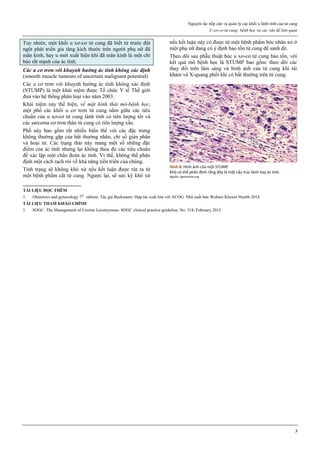 Nguyên tắc tiếp cận và quản lý các khối u lành tính của tử cung
U xơ-cơ tử cung: bệnh học và các vấn đề liên quan
3
Tuy nhiên, một khối u xơ-cơ tử cung đã biết từ trước đột
ngột phát triển gia tăng kích thước trên người phụ nữ đã
mãn kinh, hay u mới xuất hiện khi đã mãn kinh là một chỉ
báo rất mạnh của ác tính.
Các u cơ trơn với khuynh hướng ác tính không xác định
(smooth muscle tumours of uncertain malignant potential)
Các u cơ trơn với khuynh hướng ác tính không xác định
(STUMP) là một khái niệm được Tổ chức Y tế Thế giới
đưa vào hệ thống phân loại vào năm 2003.
Khái niệm này thể hiện, về mặt hình thái mô-bệnh học,
một phổ các khối u cơ trơn tử cung nằm giữa các tiêu
chuẩn của u xơ-cơ tử cung lành tính có tiên lượng tốt và
các sarcoma cơ trơn thân tử cung có tiên lượng xấu.
Phổ này bao gồm rất nhiều biến thể với các đặc trưng
không thường gặp của bất thường nhân, chỉ số gián phân
và hoại tử. Các trạng thái này mang một số những đặc
điểm của ác tính nhưng lại không thỏa đủ các tiêu chuẩn
để xác lập một chẩn đoán ác tính. Vì thế, không thể phân
định một cách rạch ròi về khả năng tiến triển của chúng.
Tình trạng sẽ không khó xử nếu kết luận được rút ra từ
một bệnh phẩm cắt tử cung. Ngược lại, sẽ sực kỳ khó xử
nếu kết luận này có được từ một bệnh phẩm bóc nhân xơ ở
một phụ nữ đang có ý định bảo tồn tử cung để sanh đẻ.
Theo dõi sau phẫu thuật bóc u xơ-cơ tử cung bảo tồn, với
kết quả mô bệnh học là STUMP bao gồm: theo dõi các
thay đổi trên lâm sàng và hình ảnh của tử cung khi tái
khám và X-quang phổi khi có bất thường trên tử cung.
Hình 8: Hình ảnh của một STUMP
Khó có thể phân định rằng đây là một cấu trúc lành hay ác tính.
Nguồn: ijpmonline.org
TÀI LIỆU ĐỌC THÊM
1. Obstetrics and gynecology 7th
edition. Tác giả Beckmann. Hợp tác xuất bản với ACOG. Nhà xuất bản Wolters Kluwer Health 2014
TÀI LIỆU THAM KHẢO CHÍNH
1. SOGC. The Management of Uterine Leiomyomas. SOGC clinical practice guideline. No. 318, February 2015.
 