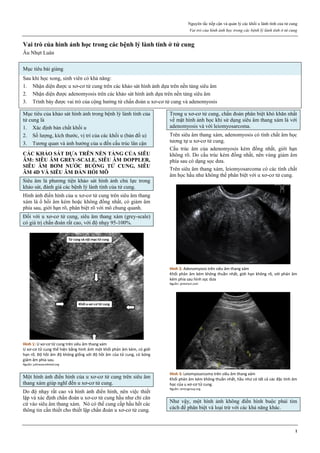 Nguyên tắc tiếp cận và quản lý các khối u lành tính của tử cung
Vai trò của hình ảnh học trong các bệnh lý lành tính ở tử cung
1
Vai trò của hình ảnh học trong các bệnh lý lành tính ở tử cung
Âu Nhựt Luân
Mục tiêu bài giảng
Sau khi học xong, sinh viên có khả năng:
1. Nhận diện được u xơ-cơ tử cung trên các khảo sát hình ảnh dựa trên nền tảng siêu âm
2. Nhận diện được adenomyosis trên các khảo sát hình ảnh dựa trên nền tảng siêu âm
3. Trình bày được vai trò của cộng hưởng từ chẩn đoán u xơ-cơ tử cung và adenomyosis
Mục tiêu của khảo sát hình ảnh trong bệnh lý lành tính của
tử cung là
1. Xác định bản chất khối u
2. Số lượng, kích thước, vị trí của các khối u (bản đồ u)
3. Tương quan và ảnh hưởng của u đến cấu trúc lân cận
CÁC KHẢO SÁT DỰA TRÊN NỀN TẢNG CỦA SIÊU
ÂM: SIÊU ÂM GREY-SCALE, SIÊU ÂM DOPPLER,
SIÊU ÂM BƠM NƯỚC BUỒNG TỬ CUNG, SIÊU
ÂM 4D VÀ SIÊU ÂM ĐÀN HỒI MÔ
Siêu âm là phương tiện khảo sát hình ảnh chủ lực trong
khảo sát, đánh giá các bệnh lý lành tính của tử cung.
Hình ảnh điển hình của u xơ-cơ tử cung trên siêu âm thang
xám là ổ hồi âm kém hoặc không đồng nhất, có giảm âm
phía sau, giới hạn rõ, phân biệt rõ với mô chung quanh.
Đối với u xơ-cơ tử cung, siêu âm thang xám (grey-scale)
có giá trị chẩn đoán rất cao, với độ nhạy 95-100%.
Hình 1: U xơ-cơ tử cung trên siêu âm thang xám
U xơ-cơ tử cung thể hiện bằng hình ảnh một khối phản âm kém, có giới
hạn rõ. Độ hồi âm độ không giống với độ hồi âm của tử cung, có bóng
giảm âm phía sau.
Nguồn: jultrasoundmed.org
Một hình ảnh điển hình của u xơ-cơ tử cung trên siêu âm
thang xám giúp nghĩ đến u xơ-cơ tử cung.
Do độ nhạy rất cao và hình ảnh điển hình, nên việc thiết
lập và xác định chẩn đoán u xơ-cơ tử cung hầu như chỉ căn
cứ vào siêu âm thang xám. Nó có thể cung cấp hầu hết các
thông tin cần thiết cho thiết lập chẩn đoán u xơ-cơ tử cung.
Trong u xơ-cơ tử cung, chẩn đoán phân biệt khó khăn nhất
về mặt hình ảnh học khi sử dụng siêu âm thang xám là với
adenomyosis và với leiomyosarcoma.
Trên siêu âm thang xám, adenomyosis có tính chất âm học
tương tự u xơ-cơ tử cung.
Cấu trúc âm của adenomyosis kém đồng nhất, giới hạn
không rõ. Do cấu trúc kém đồng nhất, nên vùng giảm âm
phía sau có dạng sọc dưa.
Trên siêu âm thang xám, leiomyosarcoma có các tính chất
âm học hầu như không thể phân biệt với u xơ-cơ tử cung.
Hình 2: Adenomyosis trên siêu âm thang xám
Khối phản âm kém không thuần nhất, giới hạn không rõ, với phản âm
kém phía sau hình sọc dưa
Nguồn: pinterest.com
Hình 3: Leiomyosarcoma trên siêu âm thang xám
Khối phản âm kém không thuần nhất, hầu như có tất cả các đặc tính âm
học của u xơ-cơ tử cung.
Nguồn: omicsgroup.org
Như vậy, một hình ảnh không điển hình buộc phải tìm
cách để phân biệt và loại trừ với các khả năng khác.
 