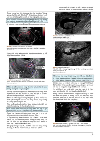 Nguyên tắc tiếp cận và quản lý các khối u lành tính của tử cung
Vai trò của hình ảnh học trong các bệnh lý lành tính ở tử cung
2
Trong trường hợp siêu âm thang xám cho hình ảnh “không
giống như hình ảnh điển hình”, thì khai thác cẩn thận bệnh
sử, tiền sử là biện pháp có ích để thực hiện phân biệt này.
Siêu âm khảo sát dòng chảy bằng Doppler cung cấp những
chi tiết giúp phân biệt trong trường hợp gặp khó khăn.
U xơ-cơ tử cung được cấp máu bằng mạch máu quanh u.
Hình 4: U xơ-cơ tử cung trên siêu âm Doppler
Khối phản âm kém khá thuần nhất, mạch máu ít, phân bố ở ngoại vi u.
Nguồn: iame.com
Ngược lại, trong adenomyosis, hình ảnh mạch máu có thể
thấy bên trong lòng khối u.
Hình 5: Adenomyosis trên siêu âm Doppler
Trong adenomyosis, phân bố mạch máu dồi dào, phân bố khắp khối u.
Nguồn: abdel-gadir.com
Khảo sát adenomyosis bằng Doppler có giá trị rất cao,
tương đương với cộng hưởng từ.
Các đặc tính trên Doppler của adenomyosis cho phép phân
biệt bệnh lý này với u xơ-cơ tử cung, với giá trị rất cao,
gần như tương đương với cộng hưởng từ.
Khảo sát adenomyosis bằng Doppler lệ thuộc nhiều vào
kinh nghiệm người đọc siêu âm, trong khi đó, cộng hưởng
từ không lệ thuộc người đọc.
Siêu âm Doppler cũng có thể khảo sát được vùng kết nối
(JZ) nhưng không rõ như cộng hưởng từ.
Siêu âm với bơm nước lòng tử cung (SIS) đặc biệt có giá
trị trong khảo sát các u xơ-cơ tử cung dưới niêm mạc.
Trong các u xơ-cơ dưới niêm mạc, phân loại vị trí có vai
trò quan trọng trong quyết định cách can thiệp.
U xơ-cơ tử cung dưới niêm mạc loại FIGO 0-1 là chỉ định
rất tốt của các can thiệp qua soi buồng tử cung, trong khi
đó, can thiệp qua soi buồng tử cung cho các u xơ-cơ tử
cung loại FIGO 2 sẽ khó khăn hơn.
SIS giúp đánh giá tỉ lệ (%) của khối u nhô vào trong buồng
tử cung, từ đó cho phân loại FIGO chính xác vị trí u.
Hình 6: U xơ-cơ tử cung FIGO 0 qua SIS.
U nằm hẳn trong lòng tử cung
Nguồn: ultrasoundforwomenpenrith.com.au
Hình 7: U xơ-cơ tử cung FIGO 1.
Trên 50% khối u ở trong lòng tử cung. Chỉ định can thiệp qua nội soi
buồng tử cung là khả thi.
Nguồn: npvfertilitycenter.com
Khi có cấu trúc trong lòng tử cung trên SIS, cần phân biệt:
1. Giữa u xơ-cơ tử cung FIGO 0 với polyps lòng tử cung
2. Giữa polyps chân rộng với u xơ-cơ tử cung FIGO 1
Đôi khi các u xơ-cơ dưới niêm mạc có cuống (FIGO 0) có
thể bị nhầm với polyp nội mạc tử cung, và ngược lại polyp
nội mạc tử cung chân rộng sẽ dễ lầm với u xơ-cơ.
Do hai bệnh lý này có ý nghĩa cũng như cách xử lý khác
nhau nên cần phải nhờ vào Doppler để phân định.
Trong u xơ-cơ dưới niêm mạc, Doppler cho thấy có hình
ảnh tưới máu quanh u. Trong khi đó, do polyp nội mạc
xuất phát hoàn toàn từ nội mạc, nên chỉ có một mạch máu
duy nhất đi vào trung tâm của polyp.
Hình 8: Phân biệt polyp và u xơ-cơ tử cung FIGO 1 bằng Doppler
Một mạch máu duy nhất đi thẳng từ nội mạc vào trung tâm của polyp.
Nguồn: dbwmpns0f8ewg.cloudfront.net
 