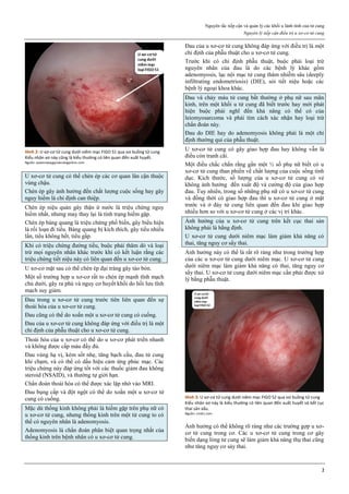Nguyên tắc tiếp cận và quản lý các khối u lành tính của tử cung
Nguyên lý tiếp cận điều trị u xơ-cơ tử cung
2
Hình 2: U xơ-cơ tử cung dưới niêm mạc FIGO S1 qua soi buồng tử cung
Kiểu nhân xơ này cũng là kiểu thường có liên quan đến xuất huyết.
Nguồn: queenswaygynaecologyclinic.com
U xơ-cơ tử cung có thể chèn ép các cơ quan lân cận thuộc
vùng chậu.
Chèn ép gây ảnh hưởng đến chất lượng cuộc sống hay gây
nguy hiểm là chỉ định can thiệp.
Chèn ép niệu quản gây thận ứ nước là triệu chứng nguy
hiểm nhất, nhưng may thay lại là tình trạng hiếm gặp.
Chèn ép bàng quang là triệu chứng phổ biến, gây biểu hiện
là rối loạn đi tiểu. Bàng quang bị kích thích, gây tiểu nhiều
lần, tiểu không hết, tiểu gấp.
Khi có triệu chứng đường tiểu, buộc phải thăm dò và loại
trừ mọi nguyên nhân khác trước khi có kết luận rằng các
triệu chứng tiết niệu này có liên quan đến u xơ-cơ tử cung.
U xơ-cơ mặt sau có thể chèn ép đại tràng gây táo bón.
Một số trường hợp u xơ-cơ rất to chèn ép mạnh tĩnh mạch
chủ dưới, gây ra phù và nguy cơ huyết khối do hồi lưu tĩnh
mạch suy giảm.
Đau trong u xơ-cơ tử cung trước tiên liên quan đến sự
thoái hóa của u xơ-cơ tử cung.
Đau cũng có thể do xoắn một u xơ-cơ tử cung có cuống.
Đau của u xơ-cơ tử cung không đáp ứng với điều trị là một
chỉ định của phẫu thuật cho u xơ-cơ tử cung.
Thoái hóa của u xơ-cơ có thể do u xơ-cơ phát triển nhanh
và không được cấp máu đầy đủ.
Đau vùng hạ vị, kèm sốt nhẹ, tăng bạch cầu, đau tử cung
khi chạm, và có thể có dấu hiệu cảm ứng phúc mạc. Các
triệu chứng này đáp ứng tốt với các thuốc giảm đau không
steroid (NSAID), và thường tự giới hạn.
Chẩn đoán thoái hóa có thể được xác lập nhờ vào MRI.
Đau bụng cấp và đột ngột có thể do xoắn một u xơ-cơ tử
cung có cuống.
Mặc dù thống kinh không phải là hiếm gặp trên phụ nữ có
u xơ-cơ tử cung, nhưng thống kinh trên một tử cung to có
thể có nguyên nhân là adenomyosis.
Adenomyosis là chẩn đoán phân biệt quan trọng nhất của
thống kinh trên bệnh nhân có u xơ-cơ tử cung.
Đau của u xơ-cơ tử cung không đáp ứng với điều trị là một
chỉ định của phẫu thuật cho u xơ-cơ tử cung.
Trước khi có chỉ định phẫu thuật, buộc phải loại trừ
nguyên nhân của đau là do các bệnh lý khác gồm
adenomyosis, lạc nội mạc tử cung thâm nhiễm sâu (deeply
infiltrating endometriosis) (DIE), sỏi tiết niệu hoặc các
bệnh lý ngoại khoa khác.
Đau và chảy máu tử cung bất thường ở phụ nữ sau mãn
kinh, trên một khối u tử cung đã biết trước hay mới phát
hiện buộc phải nghĩ đến khả năng có thể có của
leiomyosarcoma và phải tìm cách xác nhận hay loại trừ
chẩn đoán này.
Đau do DIE hay do adenomyosis không phải là một chỉ
định thường qui của phẫu thuật.
U xơ-cơ tử cung có gây giao hợp đau hay không vẫn là
điều còn tranh cãi.
Một điều chắc chắn rằng gần một ½ số phụ nữ biết có u
xơ-cơ tử cung than phiền về chất lượng của cuộc sống tình
dục. Kích thước, số lượng của u xơ-cơ tử cung có vẻ
không ảnh hưởng đến xuất độ và cường độ của giao hợp
đau. Tuy nhiên, trong số những phụ nữ có u xơ-cơ tử cung
và đồng thời có giao hợp đau thì u xơ-cơ tử cung ở mặt
trước và ở đáy tử cung liên quan đến đau khi giao hợp
nhiều hơn so với u xơ-cơ tử cung ở các vị trí khác.
Ảnh hưởng của u xơ-cơ tử cung trên kết cục thai sản
không phải là hằng định.
U xơ-cơ tử cung dưới niêm mạc làm giảm khả năng có
thai, tăng nguy cơ sẩy thai.
Ảnh hưởng này có thể là rất rõ ràng như trong trường hợp
của các u xơ-cơ tử cung dưới niêm mạc. U xơ-cơ tử cung
dưới niêm mạc làm giảm khả năng có thai, tăng nguy cơ
sẩy thai. U xơ-cơ tử cung dưới niêm mạc cần phải được xử
lý bằng phẫu thuật.
Hình 3: U xơ-cơ tử cung dưới niêm mạc FIGO S2 qua soi buồng tử cung
Kiểu nhân xơ này là kiểu thường có liên quan đến xuất huyết và kết cục
thai sản xấu.
Nguồn: cmdrc.com
Ảnh hưởng có thể không rõ ràng như các trường gợp u xơ-
cơ tử cung trong cơ. Các u xơ-cơ tử cung trong cơ gây
biến dạng lòng tử cung sẽ làm giảm khả năng thụ thai cũng
như tăng nguy cơ sảy thai.
 
