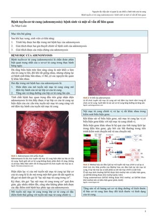 Nguyên tắc tiếp cận và quản lý các khối u lành tính của tử cung
Bệnh tuyến-cơ tử cung (adenomyosis): bệnh sinh và một số vấn đề liên quan
1
Bệnh tuyến-cơ tử cung (adenomyosis): bệnh sinh và một số vấn đề liên quan
Âu Nhựt Luân
Mục tiêu bài giảng
Sau khi học xong, sinh viên có khả năng:
1. Trình bày được hai đặc trưng mô bệnh học của adenomyosis
2. Giải thích được hai giả thuyết chính về bệnh sinh của adenomyosis
3. Giải thích được các triệu chứng của adenomyosis
BỆNH HỌC CỦA ADENOMYOSIS
Bệnh tuyến-cơ tử cung (adenomyosis) là chẩn đoán phân
biệt quan trọng nhất của u xơ-cơ tử cung trong thực hành
hàng ngày.
Dù rằng biểu hiện trên lâm sàng cùng là một khối u làm
cho tử cung to lên, đôi khi rất giống nhau, nhưng chúng lại
có bệnh sinh khác hẳn nhau, vì thế, có các nguyên tắc quản
lý khác hẳn nhau.
Hai đặc trưng mô bệnh học của adenomyosis là:
1. Hiện diện của mô tuyến nội mạc tử cung cùng mô
đệm tùy hành của nó tại lớp cơ của tử cung.
2. Tăng sản và tăng dưỡng của lớp cơ tử cung lân cận.
Tính chất bệnh học quan trọng đầu tiên giúp nhận diện
adenomyosis là tìm thấy được ở tại lớp cơ của tử cung sự
hiện diện của các cấu trúc tuyến nội mạc tử cung cùng với
mô đệm tùy hành của tuyến nội mạc tử cung.
Hình 1: Adenomyosis trên phẫu thuật
Adenomyosis là cấu trúc tuyến nội mạc tử cung hiện diện tại lớp cơ của
tử cung. Ranh giới với cơ tử cung không được phân định rõ ràng, không
có vỏ bao. Biểu hiện viêm rất rõ ràng quanh tổ chức tuyến nội mạc lạc vị.
Nguồn: fibroidsecondopinion.com
Hiện diện lạc vị của mô tuyến nội mạc tử cung tại lớp cơ
của tử cung là lý do mà trong một thời gian rất dài người ta
đã gọi nó dưới tên gọi là “lạc nội mạc tử cung trong cơ”.
Kỳ thực, tên gọi “lạc nội mạc tử cung trong cơ” quá đơn
giản, gây nhiều nhầm lẫn, cũng như không phản ánh được
các đặc điểm sinh bệnh học phức tạp của adenomyosis.
Mô tuyến nội mạc tử cung trong lớp cơ tử cung có đặc
điểm hình thái giống với tuyến nội mạc tử cung chính vị.
Hình 2: Vi thể của adenomyosis
Là tổ chức tuyến nội mạc tử cung với mô đệm tùy hành nằm trong tổ
chức cơ tử cung. Cạnh bên là các sợi cơ tử cung tăng dưỡng và tăng sản.
Nguồn: pathologyoutlines.com
Nội mạc tử cung chính vị và lạc vị rất khác nhau trong
kiểm soát biểu hiện gene.
Khi khảo sát về biểu hiện gene, nội mạc tử cung lạc vị có
biểu hiện gene khác với nội mạc tử cung chính vị.
Biểu hiện gene khác nhau là hệ quả của tình trạng lệch lạc
trong điều hòa gene, gây bởi các bất thường trong tiến
trình kiểm soát chuyển mã và sau chuyển mã.
Hình 3: Methyl hóa các đảo CpG tại mô tuyến nội mạc chính vị và lạc vị
Hình trái cho thấy profile của Methyl hóa các đảo CpG tại nội mạc tử
cung, ở tại nội mạc lạc vị (cột phải) so với nội mạc chính vị (cột trái).
Ở nội mạc bình thường GATA2 được khử methyl nên có biểu hiện gene,
và GATA6 không được khử methyl (phải, trên)
Trong andometriosis GATA2 không được khử methyl, và GATA6 được
khử methyl nên có biểu hiện gene (phải, dưới)
Nguồn: researchgate.net
Tăng sản về số lượng sợi cơ và tăng dưỡng về kích thước
tế bào cơ tử cung làm thay đổi kích thước và hình dạng
của tử cung.
 