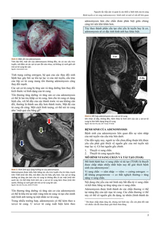 Nguyên tắc tiếp cận và quản lý các khối u lành tính của tử cung
Bệnh tuyến-cơ tử cung (adenomyosis): bệnh sinh và một số vấn đề liên quan
2
Hình 4: Mặt cắt của adenomyosis
Trên đại thể, mặt cắt của adenomyosis không đều, do có các cấu trúc
tuyến, mô đệm và các sợi cơ xen lẫn vào nhau, và không có ranh giới với
mô cơ tử cung lân cận.
Nguồn: internetdict.com
Tình trạng cường estrogen, hệ quả của các thay đổi sinh
bệnh học gây bởi sự tồn tại lạc vị của mô tuyến, cấu trúc
của lớp cơ tử cung mang tổn thương adenomyosis cũng
thay đổi mạnh.
Các sợi cơ tử cung bị tăng sản và tăng dưỡng làm thay đổi
kích thước và hình dạng của tử cung.
Tổn thương tăng dưỡng và tăng sản cơ của adenomyosis
có thể là lan tỏa khắp cơ tử cung, làm cho tử cung có dạng
hình cầu, với bề dầy của các thành trước và sau không cân
đối, thường là thành sau dầy hơn thành trước. Mật độ của
tử cung rất cứng. Một cách hình tượng, có thể nói tử cung
như “một quả cầu bằng gỗ”.
Hình 5: Hình ảnh qua cộng hưởng từ của adenomyosis
Adenomyosis được biểu hiện bằng các cấu trúc tuyến cho tín hiệu mạnh
trên T2W (mũi tên đỏ), mô đệm cho tín hiệu yếu hơn. Các sợi cơ tăng
dưỡng và tăng sản làm cho tử cung to không đều ở các mặt (mũi tên
xanh lá). Có thể thấy hình ảnh các u xơ-cơ tử cung kèm theo (mũi tên
xanh). Không có ranh giới với mô cơ tử cung lân cận.
Nguồn: Bộ môn Phụ Sản, ĐHYD TP.HCM
Tổn thương tăng dưỡng và tăng sản cơ của adenomyosis
có thể là khu trú tại một vùng trên tử cung và tạo cho mình
một hình ảnh tương tự một nhân xơ tử cung.
Trong nhiều trường hợp, adenomyosis có thể kèm theo u
xơ-cơ tử cung. U xơ-cơ tử cung xuất hiện kèm theo
adenomyosis làm cho chẩn đoán phân biệt giữa chúng
càng trở nên khó khăn hơn.
Tùy theo thành phần cấu tạo chủ yếu là tuyến hay là cơ,
adenomyosis sẽ có đặc tính hình ảnh học khác biệt.
Hình 6: Kết hợp adenomyosis và u xơ-cơ tử cung
Ghi nhận JZ dầy, không đều. Kèm theo là hình ảnh của các u xơ-cơ tử
cung to làm biến dạng lòng tử cung
Nguồn: Bộ môn Phụ Sản, ĐH Y Dược TP HCM
BỆNH SINH CỦA ADENOMYOSIS
Bệnh sinh của adenomyosis liên quan đến sự xâm nhập
của mô tuyến vào cấu trúc bên dưới.
Cho đến ngày nay, người ta vẫn chưa đồng thuận khi được
yêu cầu phải giải thích về nguồn gốc của mô tuyến nội
mạc lạc vị. Có hai nguồn gốc chính:
1. Thuyết vi sang chấn.
2. Thuyết tử cung nguyên thủy.
MÔ HÌNH VI SANG CHẤN VÀ TÁI TẠO (TIAR)
Mô hình bệnh học vi sang chấn và tái tạo (TIAR) là thuyết
được chấp nhận nhiều nhất hiện nay để giải thích bệnh
sinh của adenomyosis1
.
Vi sang chấn → xâm nhập → viêm → cường estrogen →
đề kháng progesterone → co thắt nghịch thường→ tăng
nặng vi sang chấn.
Nội dung chủ yếu của mô hình này bắt đầu từ vi sang chấn
và kết thức bằng sự tăng nặng của vi sang chấn.
Adenomyosis được hình thành do các chấn thương vi thể
tại màng đáy của nội mạc tử cung. Các chấn thương vi thể
này có thể có nguồn gốc đa dạng, tự nhiên (hình thành do
1
Dù được chấp nhận rộng rãi, nhưng mô hình này vẫn còn phải đối mặt
với nhiều vấn đề chưa được giải thích thỏa đáng.
 