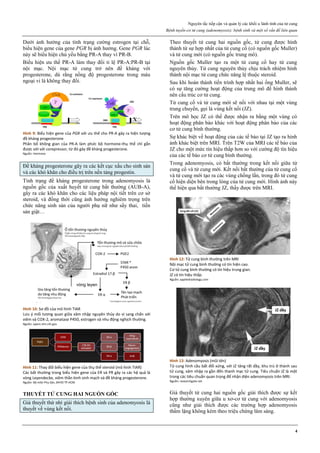 Nguyên tắc tiếp cận và quản lý các khối u lành tính của tử cung
Bệnh tuyến-cơ tử cung (adenomyosis): bệnh sinh và một số vấn đề liên quan
4
Dưới ảnh hưởng của tình trạng cường estrogen tại chỗ,
biểu hiện gene của gene PGR bị ảnh hưởng. Gene PGR lúc
này sẽ biểu hiện chủ yếu bằng PR-A thay vì PR-B.
Biểu hiện ưu thế PR-A làm thay đổi tỉ lệ PR-A:PR-B tại
nội mạc. Nội mạc tử cung trở nên đề kháng với
progesterone, dù rằng nồng độ progesterone trong máu
ngoại vi là không thay đổi.
Hình 9: Biểu hiện gene của PGR với ưu thế cho PR-A gây ra hiện tượng
đề kháng progesterone
Phân bố không gian của PR-A làm phức bộ hormone-thụ thể chỉ gắn
được với với corepressor, từ đó gây đề kháng progesterone.
Nguồn: Hormone
Đề kháng progesterone gây ra các kết cục xấu cho sinh sản
và các khó khăn cho điều trị trên nền tảng progestin.
Tình trạng đề kháng progesterone trong adenomyosis là
nguồn gốc của xuất huyết tử cung bất thường (AUB-A),
gây ra các khó khăn cho các liệu pháp nội tiết trên cơ sở
steroid, và đồng thời cũng ảnh hưởng nghiêm trọng trên
chức năng sinh sản của người phụ nữ như sẩy thai, tiền
sản giật…
Hình 10: Sơ đồ của mô hình TIAR
Lưu ý mối tương quan giữa xâm nhập nguyên thủy do vi sang chấn với
viêm và COX-2, aromatase P450, estrogen và nhu động nghịch thường.
Nguồn: openi.nlm.nih.gov
Hình 11: Thay đổi biểu hiện gene của thụ thể steroid (mô hình TIAR)
Các bất thường trong biểu hiện gene của ER và PR gây ra các hệ quả là
vòng Leyendecke, viêm thần kinh sinh mạch và đề kháng progesterone.
Nguồn: Bộ môn Phụ Sản, ĐHYD TP.HCM
THUYẾT TỬ CUNG HAI NGUỒN GỐC
Giả thuyết thứ nhì giải thích bệnh sinh của adenomyosis là
thuyết về vùng kết nối.
Theo thuyết tử cung hai nguồn gốc, tử cung được hình
thành từ sự hợp nhất của tử cung cổ (có nguồn gốc Muller)
và tử cung mới (có nguồn gốc trung mô).
Nguồn gốc Muller tạo ra một tử cung cổ hay tử cung
nguyên thủy. Tử cung nguyên thủy chịu trách nhiệm hình
thành nội mạc tử cung chức năng lệ thuộc steroid.
Sau khi hoàn thành tiến trình hợp nhất hai ống Muller, sẽ
có sự tăng cường hoạt động của trung mô đề hình thành
nên cấu trúc cơ tử cung.
Tử cung cổ và tử cung mới sẽ nối với nhau tại một vùng
trung chuyển, gọi là vùng kết nối (JZ).
Trên mô học JZ có thể được nhận ra bằng một vùng có
hoạt động phân bào khác với hoạt động phân bào của các
cơ tử cung bình thường.
Sự khác biệt về hoạt động của các tế bào tại JZ tạo ra hình
ảnh khác biệt trên MRI. Trên T2W của MRI các tế bào của
JZ cho một mức tín hiệu thấp hơn so với cường độ tín hiệu
của các tế bào cơ tử cung bình thường.
Trong adenomyosis, có bất thường trong kết nối giữa tử
cung cổ và tử cung mới. Kết nối bất thường của tử cung cổ
và tử cung mới tạo ra các vùng chồng lấn, trong đó tử cung
cổ hiện diện bên trong lòng của tử cung mới. Hình ảnh này
thể hiện qua bất thường JZ, thấy được trên MRI.
Hình 12: Tử cung bình thường trên MRI
Nội mạc tử cung bình thường có tín hiện cao.
Cơ tử cung bình thường có tín hiệu trung gian.
JZ có tín hiệu thấp.
Nguồn: appliedradiology.com
Hình 13: Adenomyosis (mũi tên)
Tử cung hình cầu bất đối xứng, với JZ tăng rất dầy, khu trú ở thành sau
tử cung, xâm nhập ra gần đến thanh mạc tử cung. Tiêu chuẩn JZ là một
trong các tiêu chuẩn quan trọng để nhận diện adenomyosis trên MRI.
Nguồn: researchgate.net
Giả thuyết tử cung hai nguồn gốc giải thích được sự kết
hợp thường xuyên giữa u xơ-cơ tử cung với adenomyosis
cũng như giải thích được các trường hợp adenomyosis
thầm lặng không kèm theo triệu chứng lâm sàng.
vòng leyen
 