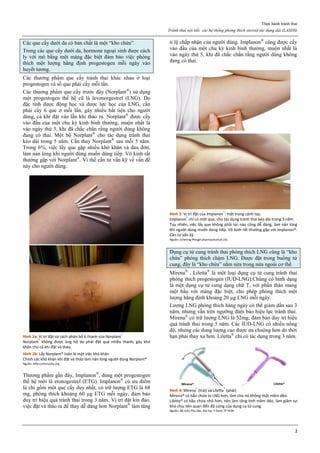 Thực hành tránh thai
Tránh thai nội tiết: các hệ thống phóng thích steroid tác dụng dài (LASDS)
2
Các que cấy dưới da có bản chất là một “kho chứa”.
Trong các que cấy dưới da, hormone ngoại sinh được cách
ly với mô bằng một màng đặc biệt đảm bảo việc phóng
thích một lượng hằng định progestogen mỗi ngày vào
huyết tương.
Các thương phẩm que cấy tránh thai khác nhau ở loại
progestogen và số que phải cấy mỗi lần.
Các thương phẩm que cấy trước đây (Norplant®
) sử dụng
một progestogen thế hệ cũ là levonorgestrel (LNG). Do
đặc tính dược động học và dược lực học của LNG, cần
phải cấy 6 que ở mỗi lần, gây nhiều bất tiện cho người
dùng, cả khi đặt vào lẫn khi tháo ra. Norplant®
được cấy
vào đầu của một chu kỳ kinh bình thường, muộn nhất là
vào ngày thứ 5, khi đã chắc chắn rằng người dùng không
đang có thai. Một bộ Norplant®
cho tác dụng tránh thai
kéo dài trong 5 năm. Cần thay Norplant®
sau mỗi 5 năm.
Trong 6%, việc lấy que gặp nhiều khó khăn và đau đớn,
làm nản lòng khi người dùng muốn dùng tiếp. Vô kinh rất
thường gặp với Norplant®
. Vì thế cần tư vấn kỹ về vấn đề
này cho người dùng.
Hình 2a: Vị trí đặt và cách phân bố 6 thanh của Norplant®
Norplant®
không được ủng hộ do phải đặt quá nhiều thanh, gây khó
khăn cho cả khi đặt và tháo.
Hình 2b: Lấy Norplant® luôn là một việc khó khăn
Chính các khó khăn khi đặt và tháo làm nản lòng người dùng Norplant®
Nguồn: Mlb-community.org
Thương phẩm gần đây, Implanon®
, dùng một progestogen
thế hệ mới là etonogestrel (ETG). Implanon®
có ưu điểm
là chỉ gồm một que cấy duy nhất, có trữ lượng ETG là 68
mg, phóng thích khoảng 60 µg ETG mỗi ngày, đảm bảo
duy trì hiệu quả tránh thai trong 3 năm. Vị trí đặt kín đáo,
việc đặt và tháo ra để thay dễ dàng hơn Norplant®
làm tăng
tỉ lệ chấp nhận của người dùng. Implanon®
cũng được cấy
vào đầu của một chu kỳ kinh bình thường, muộn nhất là
vào ngày thứ 5, khi đã chắc chắn rằng người dùng không
đang có thai.
Hình 3: Vị trí đặt của Implanon®
: mặt trong cánh tay.
Implanon®
chỉ có một que, cho tác dụng tránh thai kéo dài trong 3 năm.
Tuy nhiên, việc lấy que không phải lúc nào cũng dễ dàng, làm nản lòng
khi người dùng muốn dùng tiếp. Vô kinh rất thường gặp với Implanon®.
Cần tư vấn kỹ.
Nguồn: Schering-Plough pharmaceutical Ltd.
Dụng cụ tử cung tránh thai phóng thích LNG cũng là “kho
chứa” phóng thích chậm LNG. Được đặt trong buồng tử
cung, đây là “kho chứa” nằm nửa trong nửa ngoài cơ thể.
Mirena®
, Liletta®
là một loại dụng cụ tử cung tránh thai
phóng thích progestogen (IUD-LNG).Chúng có hình dạng
là một dụng cụ tử cung dạng chữ T, với phần thân mang
một bầu với màng đặc biệt, cho phép phóng thích một
lượng hằng định khoảng 20 µg LNG mỗi ngày.
Lượng LNG phóng thích hàng ngày có thể giảm dần sau 3
năm, nhưng vẫn trên ngưỡng đảm bảo hiệu lực tránh thai.
Mirena®
có trữ lượng LNG là 52mg, đảm bảo duy trì hiệu
quả tránh thai trong 5 năm. Các IUD-LNG có nhiều nồng
độ, nhưng các dung lượng cao được ưa chuộng hơn do thời
hạn phải thay xa hơn. Liletta®
chỉ có tác dụng trong 3 năm.
Hình 4: Mirena®
(trái) và Liletta®
(phải)
Mirena® có bầu chứa to LNG hơn, làm cho nó không thật mềm dẻo.
Liletta® có bầu chứa nhỏ hơn, nên làm tăng tính mềm dẻo, làm giảm sự
khó chịu liên quan đến độ cứng của dụng cụ tử cung.
Nguồn: Bộ môn Phụ Sản, Đại học Y Dược TP HCM
 