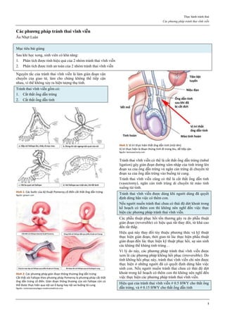 Thực hành tránh thai
Các phương pháp tránh thai vĩnh viễn
1
Các phương pháp tránh thai vĩnh viễn
Âu Nhựt Luân
Mục tiêu bài giảng
Sau khi học xong, sinh viên có khả năng:
1. Phân tích được tính hiệu quả của 2 nhóm tránh thai vĩnh viễn
2. Phân tích được tính an toàn của 2 nhóm tránh thai vĩnh viễn
Nguyên tắc của tránh thai vĩnh viễn là làm gián đoạn vận
chuyển của giao tử, làm cho chúng không thể tiếp cận
nhau, vì thế không xảy ra hiện tượng thụ tinh.
Tránh thai vĩnh viễn gồm có:
1. Cắt thắt ống dẫn trứng
2. Cắt thắt ống dẫn tinh
Hình 1: Các bước của kỹ thuật Pomeroy cổ điển cắt thắt ống dẫn trứng
Nguồn: glowm.com
Hình 2: Các phương pháp gián đoạn thông thương ống dẫn trứng
Cắt thắt vòi Fallope theo phương pháp Pomeroy là phương pháp cắt thắt
ống dẫn trứng cổ điển. Gián đoạn thông thương của vòi Fallope còn có
thể được thực hiện qua nội soi ổ bụng hay nội soi buồng tử cung.
Nguồn: contemporaryobgyn.modernmedicine.com
Hình 3: Vị trí thực hiện thắt ống dẫn tinh (mũi tên)
Vị trí thực hiện là đoạn thừng tinh đi trong bìu, dễ tiếp cận.
Nguồn: bestvasectomy.com
Tránh thai vĩnh viễn có thể là cắt thắt ống dẫn trứng (tubal
ligation) gây gián đoạn đường xâm nhập của tinh trùng lên
đoạn xa của ống dẫn trứng và ngăn cản trứng di chuyển từ
đoạn xa của ống dẫn trứng vào buồng tử cung.
Tránh thai vĩnh viễn cũng có thể là cắt thắt ống dẫn tinh
(vasectomy), ngăn cản tinh trùng di chuyển từ mào tinh
xuống túi tinh.
Tránh thai vĩnh viễn được dùng khi người dùng đã quyết
định dừng hẳn việc có thêm con.
Nếu người muốn tránh thai chưa có thái độ dứt khoát trong
kế hoạch có thêm con thì không nên nghĩ đến việc thực
hiện các phương pháp tránh thai vĩnh viễn.
Các phẫu thuật phục hồi tổn thương gây ra do phẫu thuật
gián đoạn (reversible) có hiệu quả rất thay đổi, từ khá cao
đến rất thấp.
Hiệu quả này thay đổi tùy thuộc phương thức và kỹ thuật
thực hiện gián đoạn, thời gian từ lúc thực hiện phẫu thuật
gián đoạn đến lúc thực hiện kỹ thuật phục hồi, sự sản sinh
các kháng thể kháng tinh trùng…
Vì lý do này, các phương pháp tránh thai vĩnh viễn được
xem là các phương pháp không hồi phục (irreversible). Do
tính không hồi phục này, tránh thai vĩnh viễn chỉ nên được
thực hiện ở những người đã có quyết định dừng hẳn việc
sinh con. Nếu người muốn tránh thai chưa có thái độ dứt
khoát trong kế hoạch có thêm con thì không nên nghĩ đến
việc thực hiện các phương pháp tránh thai vĩnh viễn.
Hiệu quả của tránh thai vĩnh viễn # 0.5 HWY cho thắt ống
dẫn trứng, và # 0.15 HWY cho thắt ống dẫn tinh
 