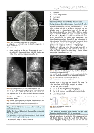 Nguyên tắc tiếp cận và quản lý các vấn đề về tuyến vú
Giải phẫu học, mô học và hình ảnh học bình thường của tuyến vú
3
Hình 4: Lắng đọng vôi bình thường ở các thể Montgomery
Tại quầng vú có thể có hình ảnh đóng vôi. Các điểm rất phân tán, chỉ
thấy duy nhất ở quầng vú.
Nguồn: radiopaedia.org
2. Đóng vôi có thể là dấu hiệu rất sớm của ác tính. Vì
thế, phân tích đặc tính của đóng vôi, nhất là đóng vôi
vi thể có thể giúp phát hiện sớm ung thư vú.
Hình 5a: (trái) Đóng vôi lớn và nhỏ trong một thương tổn ác tính
Đóng vôi có thể xuất hiện như những hạt rất mịn mũi tên kép, dưới).
Đóng vôi cũng có thể xuất hiện dưới dạng đóng vôi to (mũi tên đơn,
trên). Giải phẫu bệnh của hai thương tổn này là carcinoma in-situ ống
tuyến vú.
Hình 5b: (phải, trên) Ảnh nhìn qua kính lúp một đóng vôi nhỏ của một
carcinoma vi xâm lấn.
Hình 5c: (phải, dưới) Đóng vôi có thể xuất hiện như những hạt rất mịn.
Ảnh nhìn qua kính lúp một đóng vôi nhỏ của một carcinoma in situ.
Nguồn: breastimaging.vcu.edu (5a), meddean.luc.edu (5b) lubbockonline.com (5c)
Đóng vôi có thể là lớn (macrocalcification) hay nhỏ
(microcalcification).
Cả hai đều thường là lành tính, nhưng cả hai cùng có thể
thấy trong ác tính.
Tuy nhiên, so với đóng vôi lớn, thì đóng vôi vi thể thường
đòi hỏi một đánh giá rất thận trọng.
Các thương tổn đóng vôi sẽ được phân ra:
1. Lành tính
2. Có khả năng lành tính
3. Trung gian
4. Nghi ngờ
Siêu âm tuyến vú là khảo sát hỗ trợ cho chẩn đoán.
Không dùng cho tầm soát thường qui ở người trên 45 tuổi.
Siêu âm tuyến vú dùng các sóng âm tần số cao, 7-12 MHz,
nhằm có được hình ảnh cự ly gần với mức phân giải cao.
Siêu âm tuyến vú không có vị trí trong một tầm soát ung
thư vú theo đúng nghĩa của từ này. Chỉ có thể xem siêu âm
tuyến vú như biện pháp “khám tuyến vú” sơ cấp cho người
độ tuổi 30, có đậm độ mô vú dầy, và khi nhũ ảnh chưa
phải là nội dung tầm soát thường qui ở lứa tuổi này. Siêu
âm tuyến vú thường được dùng để kết hợp với nhũ ảnh để
thực hiện chẩn đoán khi kết quả nhũ ảnh không xác định,
hoặc để hướng dẫn sinh thiết. Siêu âm Doppler tuyến vú
giúp khảo sát dòng chảy mạch máu ở vùng nghi ngờ.
Siêu âm hữu ích trong mô tả tính chất của nang: (1) số
lượng nang, (2) hình dáng và tính chất bờ: bờ trơn láng và
mỏng hay thành dầy với chồi trong nang, (3) phản âm bên
trong trống, đồng nhất hay là u đặc.
Hình 6a: (trái) Siêu âm vú thường được dùng cho “khám tầm soát” ở
người trẻ, hay hỗ trợ cho chẩn đoán
Hình cho thấy hai cấu trúc nang ở vú trên siêu âm, với cấu tạo âm học
khác nhau, một phản âm hỗn hợp (trái) và một phản âm trống (phải).
Hình 6b: (phải) Sinh thiết nang vú hướng dẫn bởi siêu âm
Nguồn: ultrasoundpaedia.com (6a), e-ultrasonography.org (6b)
Siêu âm tuyến vú được thực hiện ở tư thế nằm ngửa. Các
chùm sóng được gửi đến thẳng đứng với bề mặt da.
Lần lượt thực hiện các lát cắt:
1. Các lát cắt theo dạng lưới dọc-ngang (grid)
2. Các lát cắt hình nan hoa và theo phương tiếp tuyến
3. Khảo sát hạch nách
Hình 10: Các lát cắt khảo sát trên siêu âm
Nguồn: ultrasoundpaedia.com
Cộng hưởng từ là phương pháp khảo sát hình ảnh được
dùng cho các đối tượng đặc biệt, có nguy cơ cao.
Kỹ thuật cộng hưởng từ (MRI) cho phép tạo ra những hình
ảnh chi tiết nhất của mô vú. Tuy nhiên MRI không được
xem là biện pháp tương đồng với nhũ ảnh cho tầm soát
 