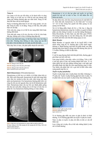 Nguyên tắc tiếp cận và quản lý các vấn đề về tuyến vú
Bệnh lý lành tính của tuyến vú
3
Nang vú
Các nang vú là do các tiểu thùy vú bị thoái triển và căng
dãn. Nang vú có thể xảy ra ở bất kỳ tuổi nào nhưng tình
trạng này không thường gặp sau mãn kinh. Nang có thể
thay đổi theo chu kỳ kinh nguyệt.
Nang vú thường phân biệt rõ với mô xung quanh, với các
đặc trưng là chắc và di động. Nang có thể đau, khó phân
biệt với mô đặc.
Trên siêu âm, nang vú có thể là các nang điển hình hoặc
không điển hình.
Trên nhũ ảnh, nang vú là các cấu trúc có bờ rõ, tròn hoặc
bầu dục, không can-xi hóa và không tăng đậm độ.
Khi có các hình ảnh nang, có thể thực hiện chọc hút bằng
kim nhỏ. Thường chọc không có máu, nang xẹp sau khi
hút dịch. Cần tái khám lại 4-6 tuần sau khi hút dịch.
Nếu chọc hút có máu, cần phải phẫu thuật để sinh thiết.
Hình 4a: Nang vú trên siêu âm
Hình 4b: Nang vú trên nhũ ảnh, phim MLO
Hình 4c: Nang vú trên nhũ ảnh, phim CC
Nguồn: radiopaedia.org (4a), ajtmh.org (4b)
Bệnh Hamartomas (Fibroadenolipomas)
Hamartomas có thể xảy ra ở nhiều vị trí khác nhau trên cơ
thể. Một cách tổng quát, hamartoma là một tình trạng lành
tính, khu trú, tương tự như tân sinh, nằm trong mô xuất
phát của hamartoma. Các hamartoma thường phát triển với
cùng tốc độ của mô nguyên thủy mà từ đó hamartoma xuất
hiện. Hamartoma được cấu tạo bởi các thành phần giống
hệt như mô xuất phát, nhưng chỉ có rối loạn về cấu trúc và
phân bố. Các hamartoma thường không có triệu chứng.
Hình 5: Nhũ ảnh của hamartoma vú, phim LMO vú phải và phim CC
Vỏ bao mỏng có mô thấu quang và cản quang xen kẽ nhau, hình ảnh
“Breast within Breast”
Nguồn: sumerdoc.blogspot.com
Hamartoma ở vú có cấu tạo gồm mô tuyến và sợi bao
quanh bởi mô mỡ và một vỏ bao. Có thể nhầm lẫn với
bướu sợi tuyến.
Do đặc điểm trên, trên lâm sàng hamartoma là một khối rất
rõ. Trên nhũ ảnh, hamartoma vú cho hình ảnh “vú trong
vú” với vỏ bao mỏng bao quanh mô thấu quang và cản
quang xen kẽ nhau.
Xử trí là bằng phẫu thuật cắt bỏ u. Cần lưu ý rằng đa
hamartoma (hamartoma cùng lúc ở nhiều cơ quan) là thành
phần của hội chứng Cowden và của hội chứng Bannayan-
Riley-Ruvalcaba, là biểu hiện của đột biến gene PTEN.
Chỉ trong trường hợp có các hội chứng này, thì mới phải
có chính sách tầm soát như đối tượng nguy cơ cao.
Bệnh Mondor
Bệnh Mondor có nguyên nhân là do huyết khối ở tĩnh
mạch nông vùng da vú, thường gặp ở tĩnh mạch ngực-
thượng vị. Bệnh thường xuất hiện sau phẫu thuật, sau chấn
thương hoặc kèm bệnh lý đông máu bất thường như yếu tố
V Leiden. Không có điều trị đặc hiệu.
U mỡ
U mỡ là sang thương lành tính khá phổ biến, thường gặp ở
giai đoạn sau tuổi sinh sản.
Lâm sàng là khối u đơn độc, mềm và di động. Trên vi thể
u mỡ bao gồm tế bào mỡ trưởng thành hình tròn. Vì vú
chứa nhiều mô mỡ nên những trường hợp u mỡ nghi ngờ
cần phẫu thuật cẩn thận lấy trọn sang thương cùng vỏ bao.
Tuy nhiên cần phân biệt với u giả mỡ là khối mềm nằm
xung quanh ung thư vú.
Tuyến vú phụ (polythelia)
Tuyến vú phụ hoặc núm vú phụ được tìm thấy ở khoảng 1-
5% phụ nữ. Tuyến vú phụ thường gặp hơn núm vú phụ. Vị
trí phát triển của các tuyến vú phụ là dọc theo đường sữa.
Hình 6a: (trái) Tuyến vú phụ ở nách
Hình 6b: (phải) Đường sữa
Nguồn: kellymom.com
Vị trí thường gặp nhất của núm vú phụ là dưới vú bình
thường. Vị trí thường gặp nhất của tuyến vú phụ là ở nách.
Núm vú phụ và tuyến vú phụ chỉ điều trị khi có vấn đề
thẩm mỹ.
Lưu ý rằng mô vú phụ vẫn có thể mắc những bệnh lý như
mô vú bình thường.
 