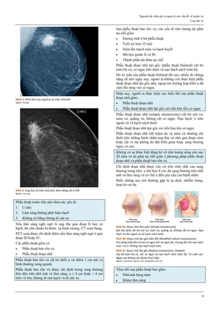 Nguyên tắc tiếp cận và quản lý các vấn đề về tuyến vú
Ung thư vú
4
Hình 2: Hình ảnh của ung thư vú trên nhũ ảnh
Nguồn: fda.gov
Hình 3: Ung thư vú trên nhũ ảnh, kèm đóng vôi vi thể
Nguồn: rsna.org
Phẫu thuật trước tiên nếu thỏa các yếu tố:
1. U nhỏ
2. Lâm sàng không phát hiện hạch
3. Không có bằng chứng di căn xa
Nếu lâm sàng nghi ngờ là ung thư giai đoạn II hay có
hạch, thì cần chuẩn bị thêm xạ hình xương, CT scan bụng.
PET scan được chỉ định thêm nếu lâm sàng nghi ngờ ở giai
đoạn III hoặc IV.
Các phẫu thuật gồm có
 Phẫu thuật bảo tồn vú
 Phẫu thuật đoạn nhũ
Phẫu thuật bảo tồn vú cắt bỏ khối u và thêm 1 cm mô vú
bình thường xung quanh.
Phẫu thuật bảo tồn vú được chỉ định trong sang thương
đơn độc trên nhũ ảnh và lâm sàng, u ≤ 4 cm hoặc > 4 cm
trên vú lớn, không di căn hạch và di căn xa.
Sau phẫu thuật bảo tồn vú, các yếu tố tiên lượng tái phát
tại chỗ gồm:
 Dương tính ở bờ phẫu thuật
 Tuổi trẻ hơn 35 tuổi
 Xâm lấn mạch máu và bạch huyết
 Mô học grade II và III
 Thành phần dư thừa tại chỗ
Phẫu thuật đoạn nhũ tận gốc (phẫu thuật Halsted) căt bỏ
toàn bộ vú, cơ ngực bên dưới và nạo hạch nách toàn bộ.
Do tử suất của phẫu thuật Halsted rất cao, nhiều di chứng
nặng nề nên ngày nay, người ta không còn thực hiện phẫu
thuật đoạn nhũ tận gốc nữa, ngoại trừ trường hợp khối u đã
xâm lấn rộng vào cơ ngực.
Hiện nay, người ta thực hiện các biến thể của phẫu thuật
đoạn nhũ gồm:
 Phẫu thuật đoạn nhũ
 Phẫu thuật đoạn nhũ tận gốc cải tiến bảo tồn cơ ngực
Phẫu thuật đoạn nhũ (simple mastectomy) cắt bỏ mô vú,
núm vú, quầng vú, không cắt cơ ngực. Nạo hạch ¼ trên
ngoài vú và hạch nách dưới.
Phẫu thuật đoạn nhũ tận gốc cải tiến bảo tồn cơ ngực.
Phẫu thuật đoạn nhũ tiết kiệm da và núm vú thường chỉ
định trên những bệnh nhân ung thư vú nhỏ giai đoạn sớm
hoặc cắt vú dự phòng do đột biến gene hoặc sang thương
nguy cơ cao.
Không có sự khác biệt đáng kể về tiên lượng sống còn sau
20 năm và tái phát tại chỗ giữa 2 phương pháp phẫu thuật
đoạn nhũ và phẫu thuật bảo tồn vú.
Chỉ định đoạn nhũ được căn cứ trên tính chất của sang
thương trung tâm, u lớn hơn 4 cm, đa sang thương trên nhũ
ảnh và lâm sàng và có chú ý đến yêu cầu của bệnh nhân.
Biến chứng sau mổ thường gặp là tụ dịch, nhiễm trùng,
hoại tử vạt da.
Hình 4a: Đoạn nhũ đơn giản (Simple mastectomy)
Đòi hỏi phải cắt bỏ mô vú, núm vú, quầng vú, không cắt cơ ngực. Nạo
hạch ¼ trên ngoài vú và hạch nách dưới.
Hình 4b: Đoạn nhũ tận gốc biến đổi (Modified radical mastectomy)
Cho phép bảo tồn cả hai cơ ngực lớn và ngực bé, nhưng đòi hỏi nạo hạch
mức I và II. Không nạo hạch nách trên.
Hình 4c: Đoạn nhũ tận gốc (Radical mastectomy: Halsted)
Lấy bỏ toàn bộ vú, các cơ ngực và nạo hạch nách toàn bộ. Tử suất cao.
Ngày nay không còn được thực hiện.
Nguồn: mayoclinic.org (1a, 1b), slideplayer.com (1c)
Theo dõi sau phẫu thuật bao gồm:
 Nhũ ảnh hàng năm
 Khám lâm sàng
 