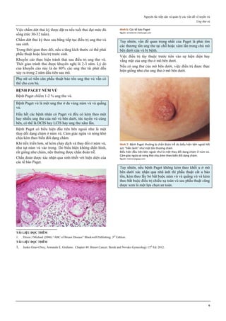 Nguyên tắc tiếp cận và quản lý các vấn đề về tuyến vú
Ung thư vú
6
Việc chấm dứt thai kỳ được đặt ra nếu tuổi thai đạt mức đủ
sống (tức 30-32 tuần).
Chấm dứt thai kỳ theo sau bằng tiếp tục điều trị ung thư vú
sau sinh.
Trong thời gian theo dõi, nếu u tăng kích thước có thể phải
phẫu thuật hoặc hóa trị trước sinh.
Khuyến cáo thực hiện tránh thai sau điều trị ung thư vú.
Thời gian tránh thai được khuyến nghị là 2-3 năm. Lý do
của khuyến cáo này là do 80% các ung thư tái phát đều
xảy ra trong 2 năm đầu tiên sau mổ.
Phụ nữ có tiền căn phẫu thuật bảo tồn ung thư vú vẫn có
thể cho con bú.
BỆNH PAGET NÚM VÚ
Bệnh Paget chiếm 1-2 % ung thư vú.
Bệnh Paget vú là một ung thư ở da vùng núm vú và quầng
vú.
Hầu hết các bệnh nhân có Paget vú đều có kèm theo một
hay nhiều ung thư của mô vú bên dưới, tức tuyến vú cùng
bên, có thể là DCIS hay LCIS hay ung thư xâm lấn.
Bệnh Paget có biểu hiện đầu tiên bên ngoài như là một
thay đổi dạng chàm ở núm vú. Cảm giác ngứa và nóng khó
chịu kèm theo biến đổi dạng chàm.
Khi tiến triển hơn, sẽ kèm chảy dịch và thay đổi ở núm vú,
như tụt núm vú vào trong. Do biểu hiện không điển hình,
rất giống như chàm, nên thường được chẩn đoán trễ.
Chẩn đoán được xác nhận qua sinh thiết với hiện diện của
các tế bào Paget.
Hình 6: Các tế bào Paget
Nguồn: emedicine.medscape.com
Tuy nhiên, vấn đề quan trọng nhất của Paget là phải tìm
các thương tổn ung thư tại chỗ hoặc xâm lấn trong chủ mô
bên dưới của vú bị bệnh.
Việc điều trị tùy thuộc trước tiên vào sự hiện diện hay
vắng mặt của ung thư ở mô bên dưới.
Nếu có ung thư của mô bên dưới, việc điều trị được thực
hiện giống như cho ung thư ở mô bên dưới.
Hình 7: Bệnh Paget thường bị chẩn đoán trễ do biểu hiện bên ngoài hết
sức “hiền lành” như một tổn thương chàm
Biểu hiện đầu tiên bên ngoài như là một thay đổi dạng chàm ở núm vú.
Cảm giác ngứa và nóng khó chịu kèm theo biến đổi dạng chàm.
Nguồn: memorangapp.com
Tuy nhiên, nếu bệnh Paget không kèm theo khối u ở mô
bên dưới xác nhận qua nhũ ảnh thì phẫu thuật cắt u bảo
tồn, kèm theo lấy bỏ bắt buộc núm vú và quầng vú và kèm
theo bắt buộc điều trị chiếu xạ toàn vú sau phẫu thuật cũng
được xem là một lựa chọn an toàn.
TÀI LIỆU ĐỌC THÊM
1. Dixon J Michael (2006) “ABC of Breast Disease” Blackwell Publishing. 3rd
Edition.
TÀI LIỆU ĐỌC THÊM
1. Junko Ozao-Choy, Armando E. Giuliano. Chapter 40: Breast Cancer. Berek and Novaks Gynecology 15th
Ed. 2012.
 