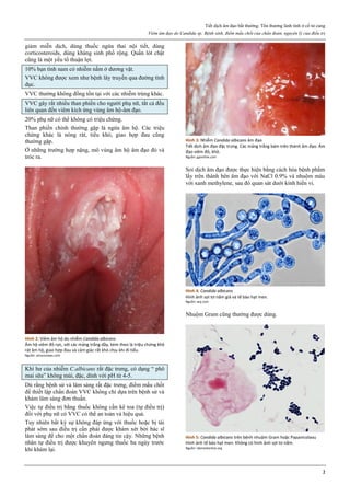 Tiết dịch âm đạo bất thường. Tổn thương lành tính ở cổ tử cung
Viêm âm đạo do Candida sp. Bệnh sinh, điểm mấu chốt của chẩn đoán, nguyên lý của điều trị
2
giảm miễn dịch, dùng thuốc ngừa thai nội tiết, dùng
corticosteroids, dùng kháng sinh phổ rộng. Quần lót chật
cũng là một yếu tố thuận lợi.
10% bạn tình nam có nhiễm nấm ở dương vật.
VVC không được xem như bệnh lây truyền qua đường tình
dục.
VVC thường không đồng tồn tại với các nhiễm trùng khác.
VVC gây rất nhiều than phiền cho người phụ nữ, tất cả đều
liên quan đến viêm kích ứng vùng âm hộ-âm đạo.
20% phụ nữ có thể không có triệu chứng.
Than phiền chính thường gặp là ngứa âm hộ. Các triệu
chứng khác là nóng rát, tiểu khó, giao hợp đau cũng
thường gặp.
Ở những trường hợp nặng, mô vùng âm hộ âm đạo đỏ và
tróc ra.
Hình 2: Viêm âm hộ do nhiễm Candida albicans
Âm hộ viêm đỏ rực, với các mảng trắng dầy, kèm theo là triệu chứng khô
rát âm hộ, giao hợp đau và cảm giác rất khó chịu khi đi tiểu.
Nguồn: amazonaws.com
Khí hư của nhiễm C.albicans rất đặc trưng, có dạng “ phô
mai sữa” không mùi, đặc, dính với pH từ 4-5.
Dù rằng bệnh sử và lâm sàng rất đặc trưng, điểm mấu chốt
để thiết lập chẩn đoán VVC không chỉ dựa trên bệnh sử và
khám lâm sàng đơn thuần.
Việc tự điều trị bằng thuốc không cần kê toa (tự điều trị)
đối với phụ nữ có VVC có thể an toàn và hiệu quả.
Tuy nhiên bất kỳ sự không đáp ứng với thuốc hoặc bị tái
phát sớm sau điều trị cần phải được khám xét bởi bác sĩ
lâm sàng để cho một chẩn đoán đáng tin cậy. Những bệnh
nhân tự điều trị được khuyên ngưng thuốc ba ngày trước
khi khám lại.
Hình 3: Nhiễm Candida albicans âm đạo
Tiết dịch âm đạo đặc trưng. Các mảng trắng bám trên thành âm đạo. Âm
đạo viêm đỏ, khô.
Nguồn: gponline.com
Soi dịch âm đạo được thực hiện bằng cách hòa bệnh phẩm
lấy trên thành bên âm đạo với NaCl 0.9% và nhuộm màu
với xanh methylene, sau đó quan sát dưới kính hiển vi.
Hình 4: Candida albicans
Hình ảnh sợi tơ nấm giả và tế bào hạt men.
Nguồn: wsj.com
Nhuộm Gram cũng thường được dùng.
Hình 5: Candida albicans trên bệnh nhuộm Gram hoặc Papanicolaou
Hình ảnh tế bào hạt men. Không có hình ảnh sợi tơ nấm.
Nguồn: labmedonline.org
 