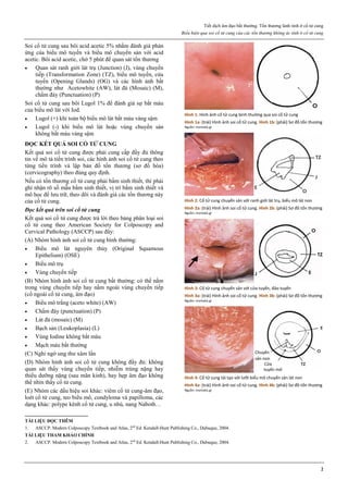 Tiết dịch âm đạo bất thường. Tổn thương lành tính ở cổ tử cung
Biểu hiện qua soi cổ tử cung của các tổn thương không ác tính ở cổ tử cung
2
Soi cổ tử cung sau bôi acid acetic 5% nhằm đánh giá phản
ứng của biểu mô tuyến và biểu mô chuyển sản với acid
acetic. Bôi acid acetic, chờ 5 phút để quan sát tổn thương
 Quan sát ranh giới lát trụ (Junction) (J), vùng chuyển
tiếp (Transformation Zone) (TZ), biểu mô tuyến, cửa
tuyến (Opening Glands) (OG) và các hình ảnh bất
thường như Acetowhite (AW), lát đá (Mosaic) (M),
chấm đáy (Punctuation) (P)
Soi cổ tử cung sau bôi Lugol 1% để đánh giá sự bắt màu
của biểu mô lát với Iod.
 Lugol (+) khi toàn bộ biểu mô lát bắt màu vàng sậm
 Lugol (-) khi biểu mô lát hoặc vùng chuyển sản
không bắt màu vàng sậm
ĐỌC KẾT QUẢ SOI CỔ TỬ CUNG
Kết quả soi cổ tử cung được phải cung cấp đầy đủ thông
tin về mô tả tiến trình soi, các hình ảnh soi cổ tử cung theo
từng tiến trình và lập bản đồ tổn thương (sơ đồ hóa)
(cervicography) theo đúng quy định.
Nếu có tổn thương cổ tử cung phải bấm sinh thiết, thì phải
ghi nhận rõ số mẫu bấm sinh thiết, vị trí bấm sinh thiết và
mô học để lưu trữ, theo dõi và đánh giá các tổn thương này
của cổ tử cung.
Đọc kết quả trên soi cổ tử cung
Kết quả soi cổ tử cung được trả lời theo bảng phân loại soi
cổ tử cung theo American Society for Colposcopy and
Cervical Pathology (ASCCP) sau đây:
(A) Nhóm hình ảnh soi cổ tử cung bình thường:
 Biểu mô lát nguyên thủy (Original Squamous
Epithelium) (OSE)
 Biểu mô trụ
 Vùng chuyển tiếp
(B) Nhóm hình ảnh soi cổ tử cung bất thường: có thể nằm
trong vùng chuyển tiếp hay nằm ngoài vùng chuyển tiếp
(cổ ngoài cổ tử cung, âm đạo)
 Biểu mô trắng (aceto white) (AW)
 Chấm đáy (punctuation) (P)
 Lát đá (mosaic) (M)
 Bạch sản (Leukoplasia) (L)
 Vùng Iodine không bắt màu
 Mạch máu bất thường
(C) Nghi ngờ ung thư xâm lấn
(D) Nhóm hình ảnh soi cổ tử cung không đầy đủ: không
quan sát thấy vùng chuyển tiếp, nhiễm trùng nặng hay
thiểu dưỡng nặng (sau mãn kinh), hay hẹp âm đạo không
thể nhìn thấy cổ tử cung.
(E) Nhóm các dấu hiệu soi khác: viêm cổ tử cung-âm đạo,
loét cổ tử cung, teo biểu mô, condyloma và papilloma, các
dạng khác: polype kênh cổ tử cung, u nhú, nang Naboth…
Hình 1: Hình ảnh cổ tử cung bình thường qua soi cổ tử cung
Hình 1a: (trái) Hình ảnh soi cổ tử cung. Hình 1b: (phải) Sơ đồ tổn thương
Nguồn: mortakis.gr
Hình 2: Cổ tử cung chuyển sản với ranh giới lát trụ, biểu mô lát non
Hình 2a: (trái) Hình ảnh soi cổ tử cung. Hình 2b: (phải) Sơ đồ tổn thương
Nguồn: mortakis.gr
Hình 3: Cổ tử cung chuyển sản với cửa tuyến, đảo tuyến
Hình 3a: (trái) Hình ảnh soi cổ tử cung. Hình 3b: (phải) Sơ đồ tổn thương
Nguồn: mortakis.gr
Hình 4: Cổ tử cung tái tạo với lưỡi biểu mô chuyển sản lát non
Hình 4a: (trái) Hình ảnh soi cổ tử cung. Hình 4b: (phải) Sơ đồ tổn thương
Nguồn: mortakis.gr
TÀI LIỆU ĐỌC THÊM
1. ASCCP. Modern Colposcopy Textbook and Atlas, 2nd
Ed. Kendall-Hunt Publishing Co., Dubuque, 2004.
TÀI LIỆU THAM KHẢO CHÍNH
2. ASCCP. Modern Colposcopy Textbook and Atlas, 2nd
Ed. Kendall-Hunt Publishing Co., Dubuque, 2004.
 