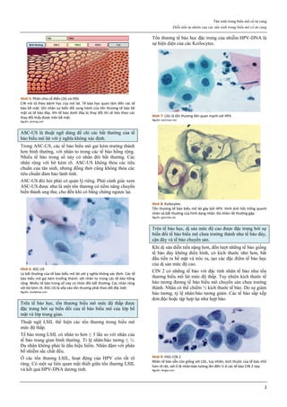 Tân sinh trong biểu mô cổ tử cung
Diễn tiến tự nhiên của các tân sinh trong biểu mô cổ tử cung
2
Hình 5: Phân chia cổ điển LSIL và HSIL
CIN mô tả theo bệnh học của mô lát. Tế bào học quan tâm đến các tế
bào bề mặt. Ghi nhận sự biến đổi song hành của tổn thương tế bào bề
mặt và tế bào đáy. Khi tế bào dưới đáy bị thay đổi thì sẽ kéo theo các
thay đổi thấy được trên bề mặt.
Nguồn: pinimg.com
ASC-US là thuật ngữ dùng để chỉ các bất thường của tế
bào biểu mô lát với ý nghĩa không xác định.
Trong ASC-US, các tế bào biểu mô gai kém trưởng thành
hơn bình thường, với nhân to trong các tế bào hồng rộng.
Nhiều tế bào trong số này có nhân đôi bất thường. Các
nhân rộng với bờ kém rõ. ASC-US không thỏa các tiêu
chuẩn của tân sinh, nhưng đồng thời cũng không thỏa các
tiêu chuẩn đảm bảo lành tính.
ASC-US đòi hỏi phải có quản lý riêng. Phải cảnh giác xem
ASC-US được như là một tổn thương có tiềm năng chuyển
biến thành ung thư, cho đến khi có bằng chứng ngược lại.
Hình 6: ASC-US
Là bất thường của tế bào biểu mô lát với ý nghĩa không xác định. Các tế
bào biểu mô gai kém trưởng thành, với nhân to trong các tế bào hồng
rộng. Nhiều tế bào trong số này có nhân đôi bất thường. Các nhân rộng
với bờ kém rõ. ASC-US bị xếp vào tổn thương phải theo dõi đặc biệt.
Nguồn: studyblue.com
Trên tế bào học, tổn thương biểu mô mức độ thấp được
đặc trưng bởi sự biến đổi của tế bào biểu mô của lớp bề
mặt và lớp trung gian.
Thuật ngữ LSIL thể hiện các tổn thương trong biểu mô
mức độ thấp.
Tế bào trong LSIL có nhân to hơn ≥ 3 lần so với nhân của
tế bào trung gian bình thường. Tỉ lệ nhân:bào tương ≤ ⅓.
Đa nhân không phải là dấu hiệu hiếm. Nhân đậm với phân
bố nhiễm sắc chất đều.
Ở các tổn thương LSIL, hoạt động của HPV còn rất rõ
ràng. Có một sự liên quan mật thiết giữa tổn thương LSIL
và kết quả HPV-DNA dương tính.
Tổn thương tế bào học đặc trưng của nhiễm HPV-DNA là
sự hiện diện của các Koilocytes.
Hình 7: LSIL là tổn thương liên quan mạnh với HPV
Nguồn: techriver.net
Hình 8: Koilocytes
Tổn thương tế bào biểu mô lát gây bởi HPV. Hình ảnh hốc trống quanh
nhân và bất thường của hình dạng nhân. Đa nhân rất thường gặp.
Nguồn: geocities.ws
Trên tế bào học, dị sản mức độ cao được đặc trưng bởi sự
biến đổi tế bào biểu mô chưa trưởng thành như tế bào đáy,
cận đáy và tế bào chuyển sản.
Khi dị sản diễn tiến nặng hơn, đến lượt những tế bào giống
tế bào đáy không điển hình, có kích thước nhỏ hơn, bắt
đầu tiến ra bề mặt và tróc ra, tạo các đặc điểm tế bào học
của dị sản mức độ cao.
CIN 2 có những tế bào với đặc tính nhân tế bào như tổn
thương biểu mô lát mức độ thấp. Tuy nhiên kích thước tế
bào tương đương tế bào biểu mô chuyển sản chưa trưởng
thành. Nhân có thể chiếm ½ kích thước tế bào. Do sự giảm
bào tương, tỷ lệ nhân:bào tương giảm. Các tế bào sắp xếp
đơn độc hoặc tập hợp lại như hợp bào.
Hình 9: HSIL-CIN 2
Nhân tế bào vẫn còn giống với LSIL, tuy nhiên, kích thước của tế bào nhỏ
hơn rõ rệt, với tỉ lệ nhân:bào tương lên đến ½ ở các tế bào CIN 2 này.
Nguồn: dingw.com
 