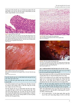 Tân sinh trong biểu mô cổ tử cung
Từ chuyển sản đến dị sản cổ tử cung
2
Trong quá trình chuyển sản, các tế bào lát sẽ phát triển rất
khác nhau, xen vào các cấu trúc tuyến. Hình thành các đảo
tuyến, nang Naboth và các cửa tuyến.
Hình 2a: Biểu mô lát non trên vi thể
Trên vi thể, biểu mô lát non được cấu tạo bởi nhiều tầng tế bào chưa
trưởng thành, tương tự với các tế bào của lớp đáy của biểu mô lát. Tuy
nhiên, bào tương rộng hơn, nhân nhỏ hơn (so với các tế bào dự trữ cận
trụ), nhiễm sắc chất cũng đồng nhất hơn. Hình ảnh này có thể gây nhầm
lẫn với tân sinh trong biểu mô mức độ cao.
Nguồn: flylib.com
Hình 2b: Biểu mô lát non trên soi cổ tử cung
Biểu mô lát non xuất phát từ SCJ nguyên thủy và “lát hóa” dần dần vùng
lộ tuyến.
Nguồn: mortakis.hpvinfocenter.gr
Sau khi chuyển sản xảy ra, hình thành một ranh giới lát trụ
mới, được gọi là SCJ mới.
Khu vực giữa SCJ gốc hoặc bản địa và SCJ mới là vùng
chuyển tiếp.
Các tế bào chuyển sản là các tế bào non, rất nhạy với mọi
tác động từ môi trường. HPV có thể tấn công các tế bào
này và gây ra dị sản cổ tử cung.
Sau khi chuyển sản xảy ra, hình thành một SCJ mới. Khu
vực giữa SCJ gốc và SCJ mới là vùng chuyển tiếp. Vào
cuối tiến trình chuyển sản, các biểu mô lát non sẽ hoàn
toàn chuyển đổi thành biểu mô lát trưởng thành, và lấp kín
vùng lộ tuyến. Biểu mô lát trưởng thành có cấu tạo giống
hệt biểu mô lát nguyên thủy.
Hình 3a: Biểu mô lát chuyển sản trưởng thành
Hầu như không thể phân biệt với biểu mô lát nguyên thủy
Nguồn: win.eurocytology.eu
Hình 3b: Tiến trình chuyển sản đang tiến triển
Trên hình, các lưỡi biểu mô lát chuyển sản trưởng thành đã bắt được
màu lugol. Hình ảnh này thấy được trên vùng chuyển tiếp. Sự tiến triển
của tiến trình chuyển sản không đồng đều.
Nguồn: keyword-suggestions.com
QUÁ TRÌNH HÌNH THÀNH DỊ SẢN CỔ TỬ CUNG
Dị sản là kết quả của tác động bên ngoài vào các tế bào
non nớt của quá trình chuyển sản sinh lý.
Quá trình chuyển sản diễn ra trong điều kiện bình thường
sẽ giúp phục hồi các vùng tổn thương trên cổ tử cung.
Nếu có sự tác động của các tác nhân trong môi trường bên
ngoài xảy ra trong quá trình chuyển sản, chẳng hạn hóa
chất, tia xạ, virus (đặc biệt là HPV) sẽ gây ra dị sản
(dysplasia) tức tân sinh trong biểu mô cổ tử cung (CIN).
HPV ức chế các hoạt động apoptosis của tế bào chuyển
sản và can thiệp trên điều hòa tăng trưởng của các tế bào
này. Như vậy, HPV là điều cần để gây dị sản và ung thư.
HPV xâm nhập thành công vào tế bào chủ sẽ giải mã các
đoạn gene E6 và E7. E6 của HPV sẽ bất hoạt p53, còn E7
của HPV sẽ bất hoạt pRb.
 p53 là một protein có tính năng ngăn chặn ung thư
của tế bào. p53 hoạt động bằng cơ chế ức chế hiện
 