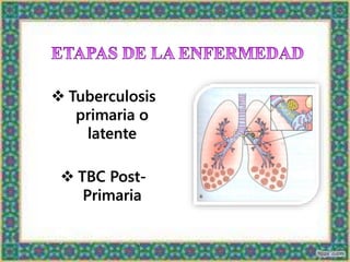  Tuberculosis
primaria o
latente
 TBC Post-
Primaria
 