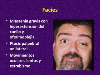 Facies
• Miastenia gravis con
  hiperextensiòn del
  cuello y
  oftalmoplejìa.
• Ptosis palpebral
  unilateral.
• Movimientos
  oculares lentos y
  estrabismo
 