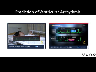Prediction ofVentricular Arrhythmia
 