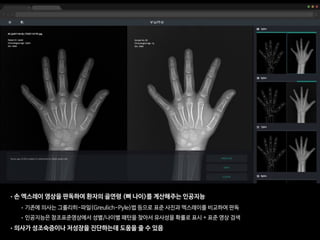 •손 엑스레이 영상을 판독하여 환자의 골연령 (뼈 나이)를 계산해주는 인공지능

• 기존에 의사는 그룰리히-파일(Greulich-Pyle)법 등으로 표준 사진과 엑스레이를 비교하여 판독

• 인공지능은 참조표준영상에서 성별/나이별 패턴을 찾아서 유사성을 확률로 표시 + 표준 영상 검색

•의사가 성조숙증이나 저성장을 진단하는데 도움을 줄 수 있음
 