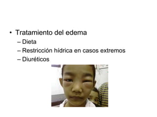 • Tratamiento del edema
– Dieta
– Restricción hídrica en casos extremos
– Diuréticos
 