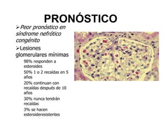 PRONÓSTICO
Peor pronóstico en
síndrome nefrótico
congénito
Lesiones
glomerulares mínimas
98% responden a
esteroides
50% 1 o 2 recaídas en 5
años
20% continuan con
recaídas después de 10
años
30% nunca tendrán
recaídas
3% se hacen
esteroideresistentes
 