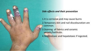 Side effects and their prevention
1.It is corrosive and may cause burns
2.Temporary skin and nail discolouration are
common.
3.Staining of fabrics and ceramic
vessels/bathtubs.
4.Nephrotoxic and hepatotoxic if ingested.
 