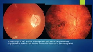 SYMPATHETIC OPHTHALMIA & VKH SYNDROME | PPTX