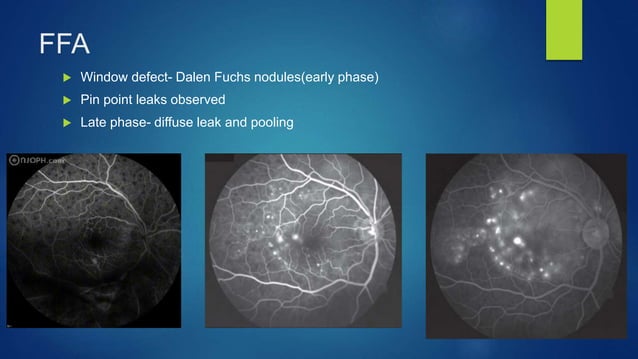 Sympathetic Ophthalmia And Vkh Syndrome Ppt