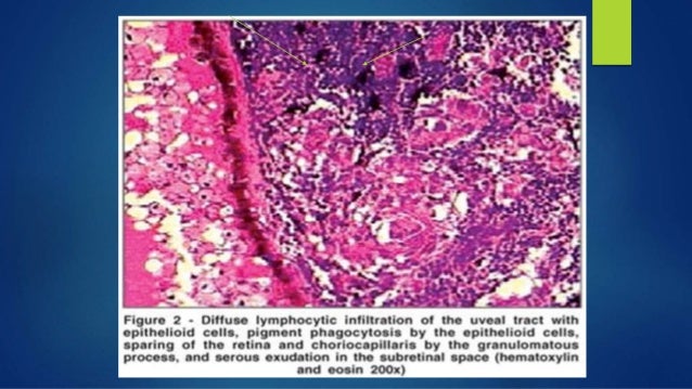 sympathetic ophthalmia vkh syndrome uveal tract