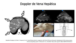 2. Doppler de Vena Hepática
Beaubien-Souligny, W., Rola, P., Haycock, K. et al. Quantifying systemic congestion with Point-Of-Care ultrasound: development of the venous excess
ultrasound grading system. Ultrasound J 12, 16 (2020). https://doi.org/10.1186/s13089-020-00163-w
Doppler de Vena Hepática
 