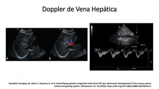 2. Doppler de Vena Hepática
Beaubien-Souligny, W., Rola, P., Haycock, K. et al. Quantifying systemic congestion with Point-Of-Care ultrasound: development of the
venous excess ultrasound grading system. Ultrasound J 12, 16 (2020). https://doi.org/10.1186/s13089-020-00163-w
Beaubien-Souligny, W., Rola, P., Haycock, K. et al. Quantifying systemic congestion with Point-Of-Care ultrasound: development of the venous excess
ultrasound grading system. Ultrasound J 12, 16 (2020). https://doi.org/10.1186/s13089-020-00163-w
Doppler de Vena Hepática
 