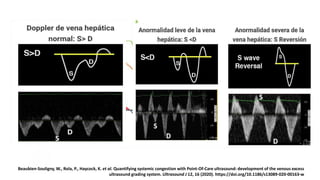 2. Doppler de Vena Hepática
Beaubien-Souligny, W., Rola, P., Haycock, K. et al. Quantifying systemic congestion with Point-Of-Care ultrasound: development of the
venous excess ultrasound grading system. Ultrasound J 12, 16 (2020). https://doi.org/10.1186/s13089-020-00163-w
Beaubien-Souligny, W., Rola, P., Haycock, K. et al. Quantifying systemic congestion with Point-Of-Care ultrasound: development of the venous excess
ultrasound grading system. Ultrasound J 12, 16 (2020). https://doi.org/10.1186/s13089-020-00163-w
 
