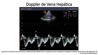 Doppler de Vena Hepática
Tung-Chen Y, García de Casasola-Sánchez G, Méndez-Bailón Medición de la congestión venosa empleando la ecografía: protocolo VExUS. Galicia Clin 2022; 83-2: 32
37 doi.org/10.22546/65/2621
 