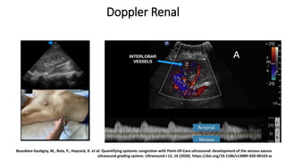 4. Doppler de Vena Intrarrenal
Beaubien-Souligny, W., Rola, P., Haycock, K. et al. Quantifying systemic congestion with Point-Of-Care ultrasound: development of the
venous excess ultrasound grading system. Ultrasound J 12, 16 (2020). https://doi.org/10.1186/s13089-020-00163-w
Beaubien-Souligny, W., Rola, P., Haycock, K. et al. Quantifying systemic congestion with Point-Of-Care ultrasound: development of the venous excess
ultrasound grading system. Ultrasound J 12, 16 (2020). https://doi.org/10.1186/s13089-020-00163-w
Doppler Renal
 