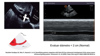 1.VCI
Evaluar diámetro < 2 cm (Normal)
Beaubien-Souligny, W., Rola, P., Haycock, K. et al. Quantifying systemic congestion with Point-Of-Care ultrasound: development of the venous excess
ultrasound grading system. Ultrasound J 12, 16 (2020). https://doi.org/10.1186/s13089-020-00163-w
 