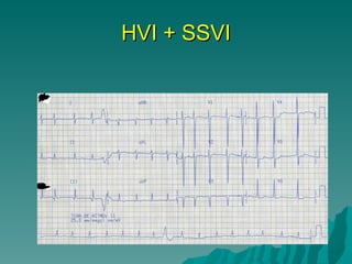 HVI + SSVI 
