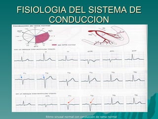FISIOLOGIA DEL SISTEMA DE CONDUCCION Ritmo sinusal normal con conducción de rama normal 